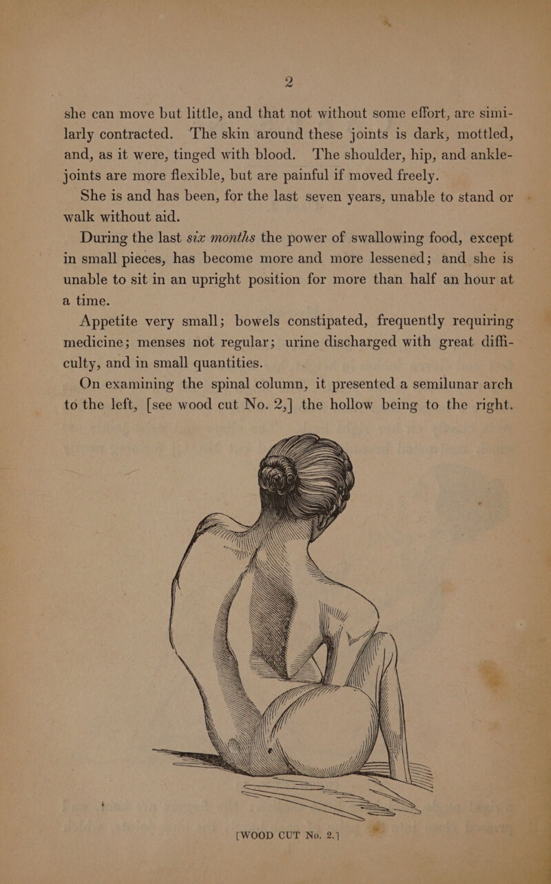 she can move but little, and that not without some effort, are simi- larly contracted. The skin around these joints is dark, mottled, and, as it were, tinged with blood. The shoulder, hip, and ankle- joints are more flexible, but are painful if moved freely. ‘She is and has been, for the last seven years, unable to stand or walk without aid. During the last sez months the power of swallowing food, except in small pieces, has become more and more lessened; and she is unable to sit in an upright position for more than half an hour at a time. } Appetite very small; bowels constipated, frequently requiring medicine; menses not regular; urine discharged with great diffi- culty, and in small quantities. On examining the spinal column, it presented a semilunar arch to the left, [see wood cut No. 2,] the hollow being to the right.