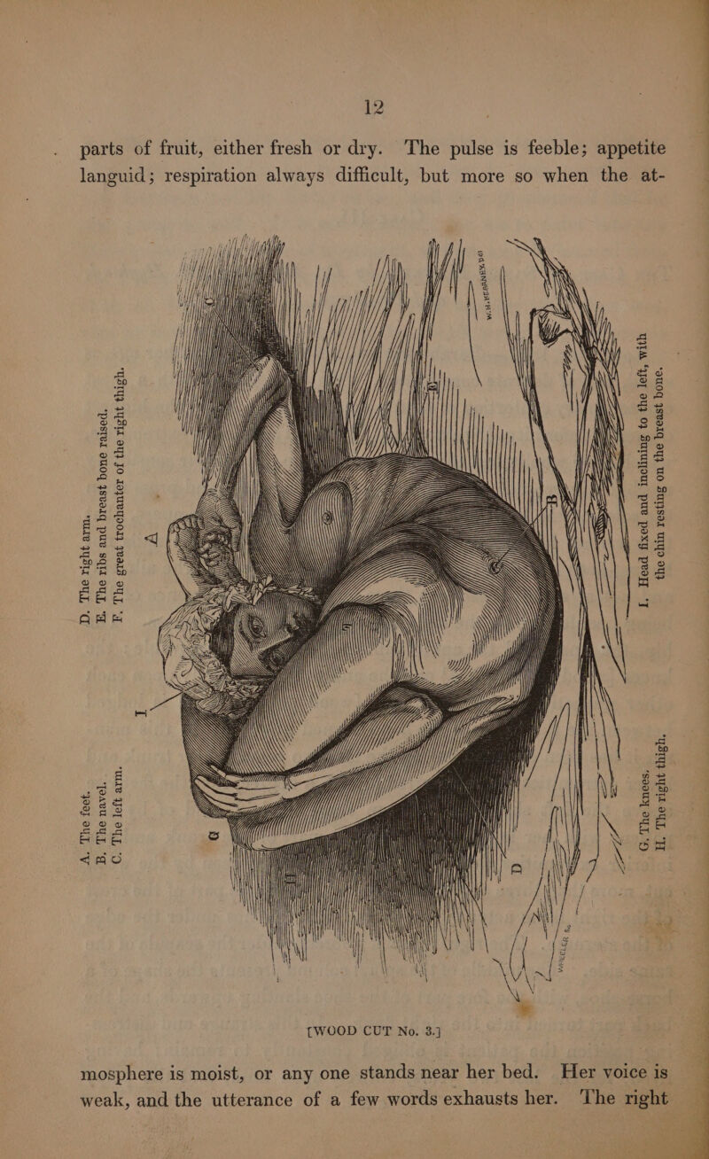 ] . parts of fruit, either fresh or dry. The pulse is feeble; appetite : y *dTOG JSVIIG 9Y} UO SuIsot UIYO 9} *YSIY} JUST OU, “TH UTM “4JoT OY} 0} Surulpour pue pexy peoyy *] *soouy ory, “HD =— == The right LL [WOOD CUT No. 3.] SS — = —— —— = —— ———————— languid; respiration always difficult, but more so when the at- mosphere is moist, or any one stands near her bed. Her voiceis _ weak, and the utterance of a few words exhausts her. YSIY} WYSIA Vy} JO LoyWeyooI} Yeats oy, “yy WIR IJOT OUT, “OC “pastel eUuog 4ysvoig puUR SqII oy, “| ‘oar ou, ‘“g MI JUS IL, “ *J09j OULL “V