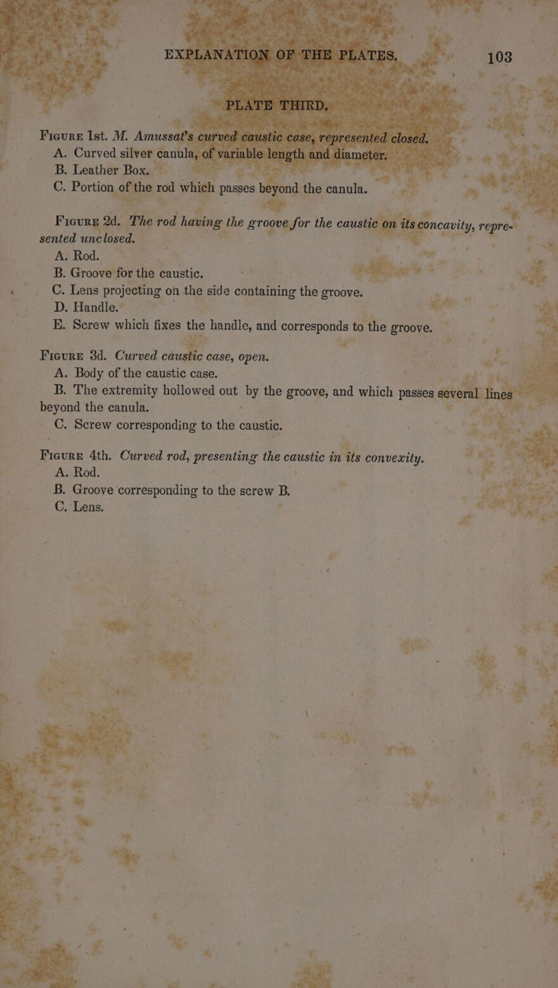 A. Curved silver canul: le, 0 B. Leather ul PE. The hie having the rome fr the caustic 0 à sented unclosed. we A. Rod. à B. Groove for the caustic. ; ss C. Lens projecting on the side containing the groove. D. Handle.’ ii | | E. Screw which fixes the handle, and corresponds to the Bronye. : ¥ ¢ ty? Fioure 3d. Curved cau: ic case, open. à Le TOR A. Body of the caustic case. rl oy a B. The extremity hollowed out by the groove, and which passes several lines beyond the canula. à 1 C. Screw corresponding to the caustic. | 1: te WW ou 4th. Curved rod, presenting the caustic afte convexity. A. Rod. B. Groove corresponding to the screw B, C. Lens. d # rd à a +} eS at » = - va . t - A RS x * \ pt 7 ay 4 ‘at | | ; 1 22 te ; NU tee | ¥ “ops. J + &amp; Le va à r io Px a st &amp; Fe