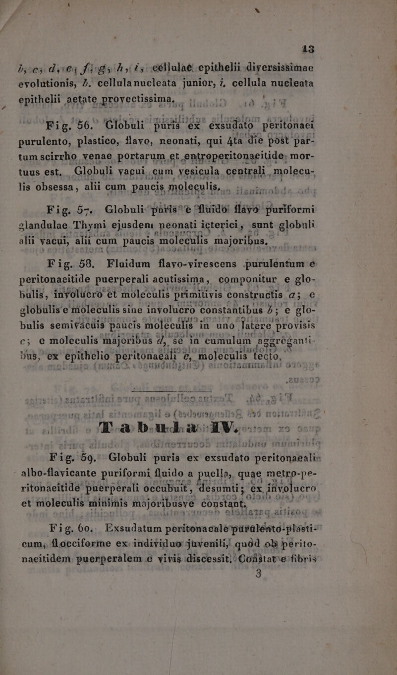AS bc; dései figs hy £5; edllalae epithelii dirersissimae evolutionis, 7. PeRulé nuclei: junior, 7, cellula nueleata SPARSIS Sglhto Broveetingimds, WT A ru Fig. 56. Globuli pa 'éx 'éxsüdato- peritonaei purulento, plastico, flavo, neonati, qui Ata die post par- tumscirrho venae portarum et , entroperitonaeitide: mor- tuus est. Globuli vacui. cum yesicula centrali , molecu- lis obsessa , alii cum paucis moleculis, Pr AR NE WR Fig. 57. Globuli pakis'e fluido: fláyó puriformi glandulae Thymi ejusdeni ,Reonati icterici, sunt globuli alii vacui, alii cum paucis. moleculis majoribus, T TITILIA Fig. 5. Hlaiddm flavo- virescens purulentum e peritonacitide puerperali acutissima, componitur e glo- bulis, inyolücro et moleculis primitivis c constructis 2; € globulis'e moleculis sine involucro t constantibus 5; e elo- bulis semitácuig paucis moleculis' in uno latere provisis c; e moleculis majoribus d, se in cumulum aggréganti- Dus, ex Wis. perltótnddli e, moletulis tecto, RIOT L^. IEHO H APA H » i04 Wm [Otb5:Iiu ME Mi 9 ( $3d939t9p i15] 5*4 noun 7 a D. udi a av. t x9 c f MIAUSO JD 18115 Fig. Lo. Globali | piti ex Mere peritonaeali: | albo-flavicante puriformi fluido a puella, quae metro-pe- vitonaeitide puerperali occubuit , desumti; ex. divolucro. et moleculis minimis mojoribusve onstadt, itis s à h olsiiatrq ariieoq Fig. áo. DERdaen peritonaealepürülerito:plásti- cum; flocciforme ex individuo jüvenili; quód ol perito- naeitidem. puerperalem e vivis :discessit;^ Cosstat:e fibris 3