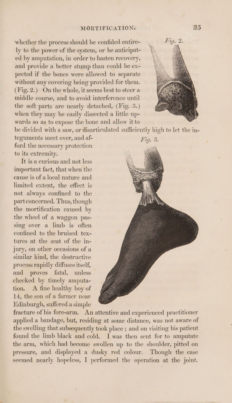 whether the process should be confided entire- ly to the power of the system, or be anticipat- ed by amputation, in order to hasten recovery, and provide a better stump than could be ex- pected if the bones were allowed to separate without any covering being provided for them. (Fig. 2.) On the whole, it seems best to steer a middle course, and to avoid interference until the soft parts are nearly detached, (Fig. 3.) when they may be easily dissected a little up- wards so as to expose the bone and allow it to teguments meet over, and af- ford the necessary protection to its extremity. It is a curious and not less cause is of a local nature and limited extent, the effect is not always confined to the part concerned. Thus, though the mortification caused by the wheel of a waggon pas- sing over a limb is often confined to the bruised tex- tures at the seat of the in- jury, on other occasions of a similar kind, the destructive process rapidly diffuses itself, and proves fatal, unless checked by timely amputa- tion. &lt;A fine healthy boy of 14, the son of a farmer near Edinburgh, suffered a simple