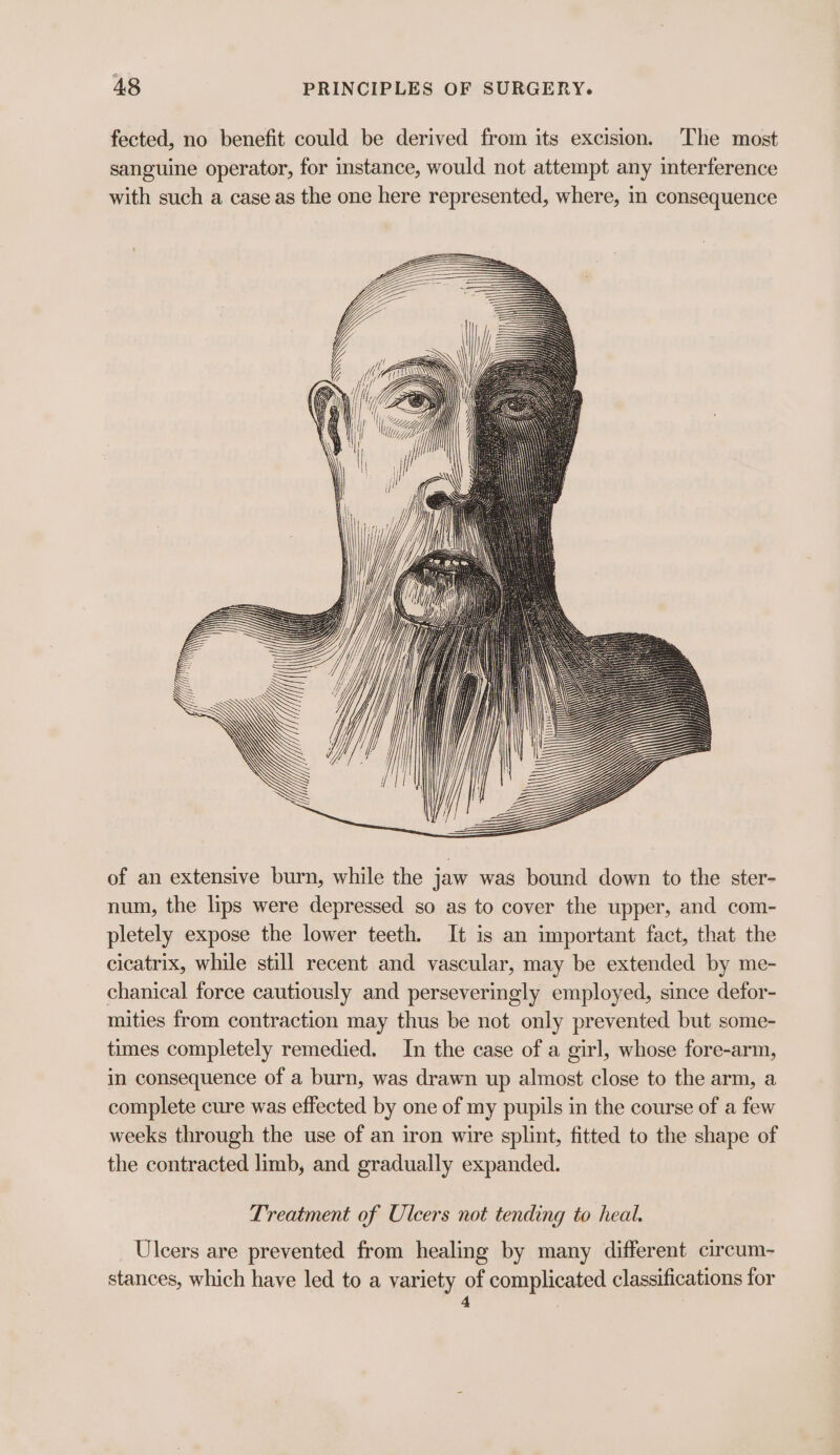 fected, no benefit could be derived from its excision. The most sanguine operator, for instance, would not attempt any interference with such a case as the one here represented, where, i consequence of an extensive burn, while the jaw was bound down to the ster- num, the lips were depressed so as to cover the upper, and com- pletely expose the lower teeth. It is an important fact, that the cicatrix, while still recent and vascular, may be extended by me- chanical force cautiously and perseveringly employed, since defor- mities from contraction may thus be not only prevented but some- times completely remedied. In the case of a girl, whose fore-arm, in consequence of a burn, was drawn up almost close to the arm, a complete cure was effected by one of my pupils in the course of a few weeks through the use of an iron wire splint, fitted to the shape of the contracted limb, and gradually expanded. Treatment of Ulcers not tending to heal. Ulcers are prevented from healing by many different circum- stances, which have led to a variety of complicated classifications for 4