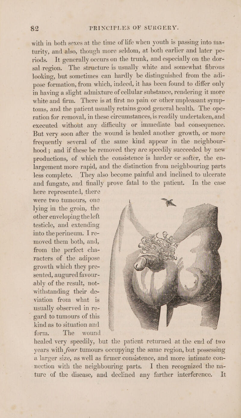 with in both sexes at the time of life when youth is passing into ma- turity, and also, though more seldom, at both earlier and later pe- riods. It generally occurs on the trunk, and especially on the dor- sal region. The structure is usually white and somewhat fibrous looking, but sometimes can hardly be distinguished from the adi- pose formation, from which, indeed, it has been found to differ only in having a slight admixture of cellular substance, rendering it more white and firm. There is at first no pain or other unpleasant symp- toms, and the patient usually retams good general health. The ope- ration for removal, in these circumstances, is readily undertaken, and executed without any difficulty or immediate bad consequence. But very soon after the wound is healed another growth, or more frequently several of the same kind appear in the neighbour- hood ; and if these be removed they are speedily succeeded by new productions, of which the consistence is harder or softer, the en- largement more rapid, and the distinction from neighbouring parts less complete. They also become painful and inclined to ulcerate and fungate, and finally prove fatal to the patient. In the case here represented, there were two tumours, one lying in the groin, the other enveloping the left testicle, and extending \ into the perineum. I re- \ es == € i Ss Nc Won moved them both, and, \ \ WKED VS \ ()) = &lt; from the perfect cha- racters of the adipose growth which they pre- sented, augured favour- ably of the result, not- withstanding their de- viation from what is usually observed in re- - gard to tumours of this kind as to situation and form. The wound healed very speedily, but the patient returned at the end of two years with four tumours occupying the same region, but possessing a larger size, as well as firmer consistence, and more intimate con- nection with the neighbouring parts. I then recognized the na- ture of the disease, and declined any farther interference. It YE: WUIPTLSAI LL Ye Z WME YW ty Wi q;