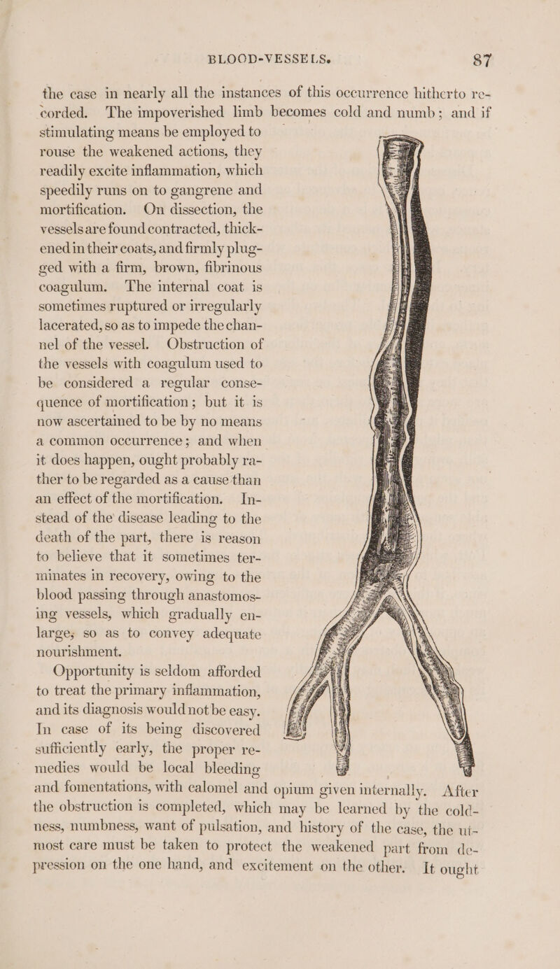 stimulating means be employed to rouse the weakened actions, they readily excite inflammation, which speedily runs on to gangrene and mortification. On dissection, the vessels are found contracted, thick- ened in their coats, and firmly plug- ged with a firm, brown, fibrinous coagulum. The internal coat is sometimes ruptured or irregularly lacerated, so as to impede the chan- nel of the vessel. Obstruction of the vessels with coagulum used to be considered a regular conse- quence of mortification; but it is now ascertained to be by no means a common occurrence; and when it does happen, ought probably ra- ther to be regarded as a cause than an effect of the mortification. In- stead of the disease leading to the death of the part, there is reason to believe that it sometimes ter- minates in recovery, owing to the blood passing through anastomos- ing vessels, which gradually en- large; so as to convey adequate nourishment. Opportunity is seldom afforded to treat the primary inflammation, and its diagnosis would not be easy. In case of its being discovered sufficiently early, the proper re- medies would be local bleeding