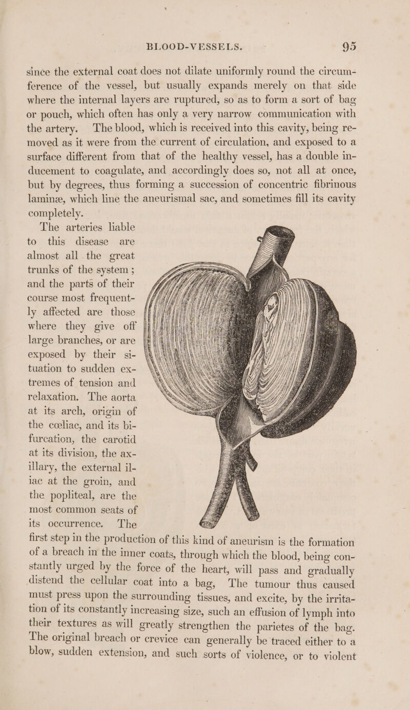 since the external coat does not dilate uniformly round the circum- ference of the vessel, but usually expands merely on that side where the internal layers are ruptured, so as to form a sort of bag or pouch, which often has only a very narrow communication with the artery. The blood, which is received into this cavity, being re- moved as it were from the current of circulation, and exposed to a surface different from that of the healthy vessel, has a double m- ducement to coagulate, and accordingly does so, not all at once, but by degrees, thus forming a succession of concentric fibrinous lamine, which line the aneurismal sac, and sometimes fill its cavity completely. The arteries lable to this disease are almost all the great trunks of the system ; and the parts of their course most frequent- ly affected are those where they give off large branches, or are exposed by their si- tuation to sudden ex- tremes of tension and relaxation. The aorta at its arch, origin of the cceliac, and its bi- furcation, the carotid at its division, the ax- illary, the external il- iac at the groin, and the popliteal, are the most common seats of its occurrence. The C2: first step in the production of this kind of aneurism is the formation of a breach in the inner coats, through which the blood, being con- stantly urged by the force of the heart, will pass and gradually distend the cellular coat into a bag, The tumour thus caused must press upon the surrounding tissues, and excite, by the irrita- tion of its constantly increasing size, such an effusion of lymph into their textures as will greatly strengthen the parietes of the bag. The original breach or crevice can generally be traced either to a blow, sudden extension, and such sorts of violence, or to violent