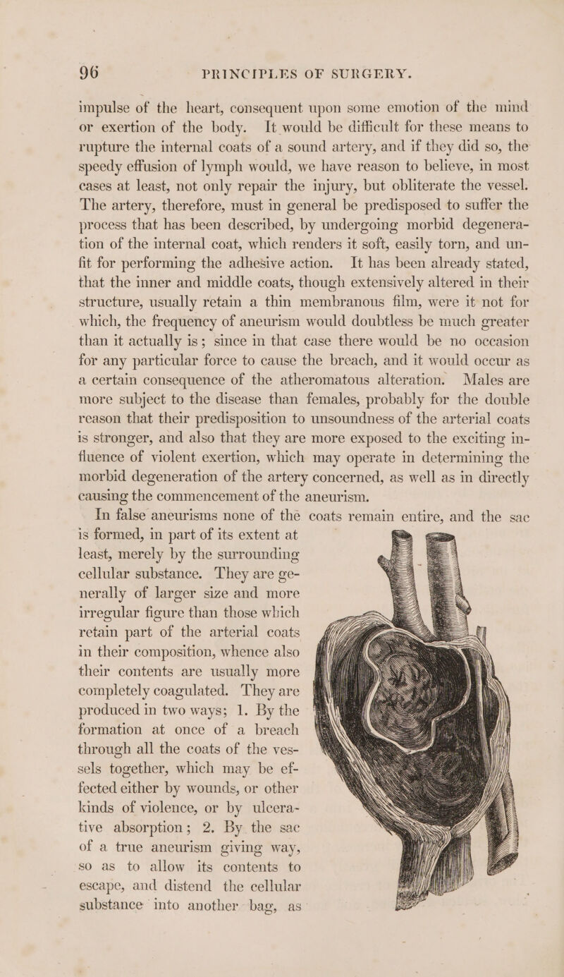 impulse of the heart, consequent upon some emotion of the mind or exertion of the body. It would be difficult for these means to rupture the internal coats of a sound artery, and if they did so, the speedy effusion of lymph would, we have reason to believe, im most cases at least, not only repair the injury, but obliterate the vessel. The artery, therefore, must in general be predisposed to suffer the process that has been described, by undergoing morbid degenera- tion of the internal coat, which renders it soft, easily torn, and un- fit for performing the adhesive action. It has been already stated, that the inner and middle coats, though extensively altered in their structure, usually retam a thin membranous film, were it not for which, the frequency of aneurism would doubtless be much greater than it actually is; since in that case there would be no occasion for any particular force to cause the breach, and it would occur as a certain consequence of the atheromatous alteration. Males are more subject to the disease than females, probably for the double reason that their predisposition to unsoundness of the arterial coats is stronger, and also that they are more exposed to the exciting in- fluence of violent exertion, which may operate in determining the morbid degeneration of the artery concerned, as well as in directly causing the commencement of the aneurism. In false aneurisms none of the coats remain entire, and the sac is formed, in part of its extent at | &lt;&gt; least, merely by the surrounding : cellular substance. They are ge- nerally of larger size and more irregular figure than those which retain part of the arterial coats in their composition, whence also their contents are usually more completely coagulated. They are produced in two ways; 1. By the formation at once of a breach through all the coats of the ves- sels together, which may be ef- fected either by wounds, or other kinds of violence, or by ulcera- tive absorption; 2. By the sac of a true aneurism giving way, so as to allow its contents to escape, and distend the cellular substance into another bag, as