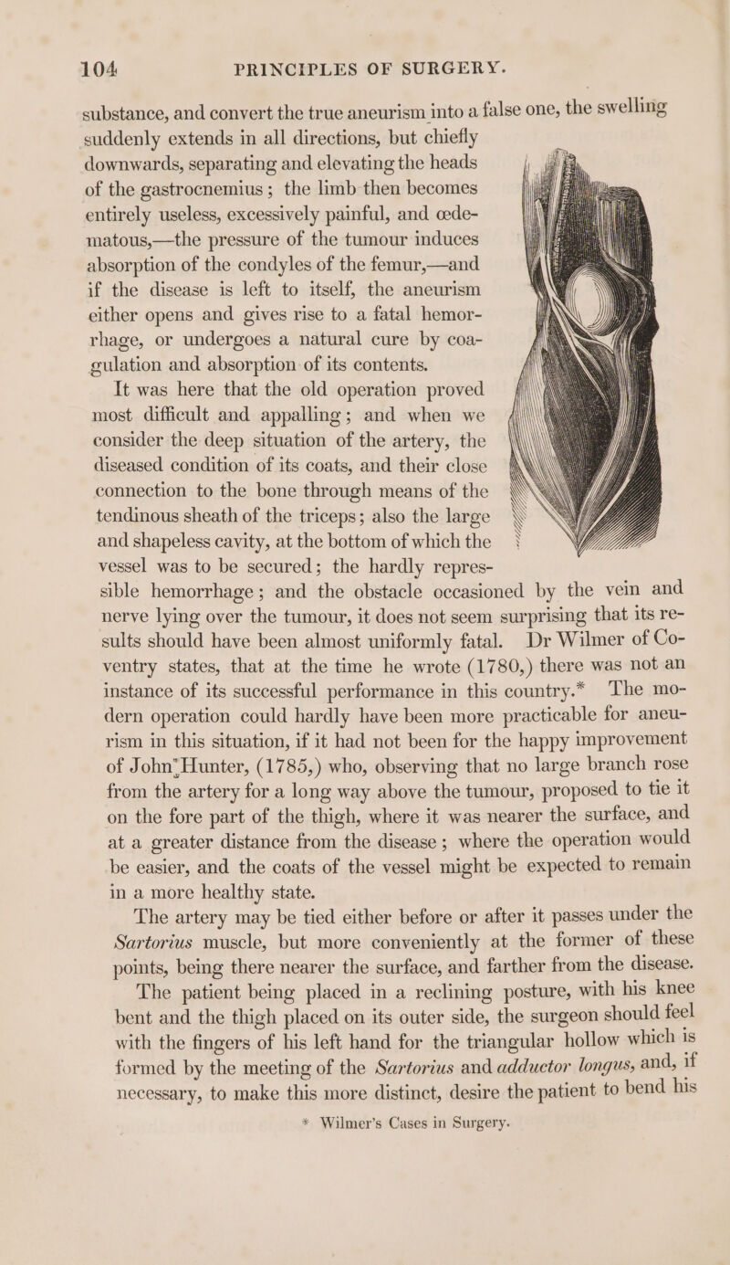 substance, and convert the true aneurism into a false one, the swelling suddenly extends in all directions, but chiefly downwards, separating and elevating the heads of the gastrocnemius ; the limb then becomes entirely useless, excessively painful, and. cede- matous,—the pressure of the tumour induces absorption of the condyles of the femur,—and if the disease is left to itself, the aneurism either opens and gives rise to a fatal hemor- rhage, or undergoes a natural cure by coa- culation and absorption of its contents. It was here that the old operation proved most difficult and appalling; and when we consider the deep situation of the artery, the diseased condition of its coats, and their close connection to the bone through means of the tendinous sheath of the triceps; also the large and shapeless cavity, at the bottom of which the vessel was to be secured; the hardly repres- sible hemorrhage; and the obstacle occasioned by the vein and nerve lying over the tumour, it does not seem surprising that its re- sults should have been almost uniformly fatal. Dr Wilmer of Co- ventry states, that at the time he wrote (1780,) there was not an instance of its successful performance in this country.* The mo- dern operation could hardly have been more practicable for aneu- rism in this situation, if it had not been for the happy improvement of John® Hunter, (1785,) who, observing that no large branch rose from the artery for a long way above the tumour, proposed to tie it on the fore part of the thigh, where it was nearer the surface, and at a greater distance from the disease ; where the operation would be easier, and the coats of the vessel might be expected to remain in a more healthy state. The artery may be tied either before or after it passes under the Sartorius muscle, but more conveniently at the former of these points, being there nearer the surface, and farther from the disease. The patient being placed in a reclining posture, with his knee — bent and the thigh placed on its outer side, the surgeon should feel with the fingers of his left hand for the triangular hollow which is formed by the meeting of the Sartorius and adductor longus, and, if necessary, to make this more distinct, desire the patient to bend his * Wilmer’s Cases in Surgery.