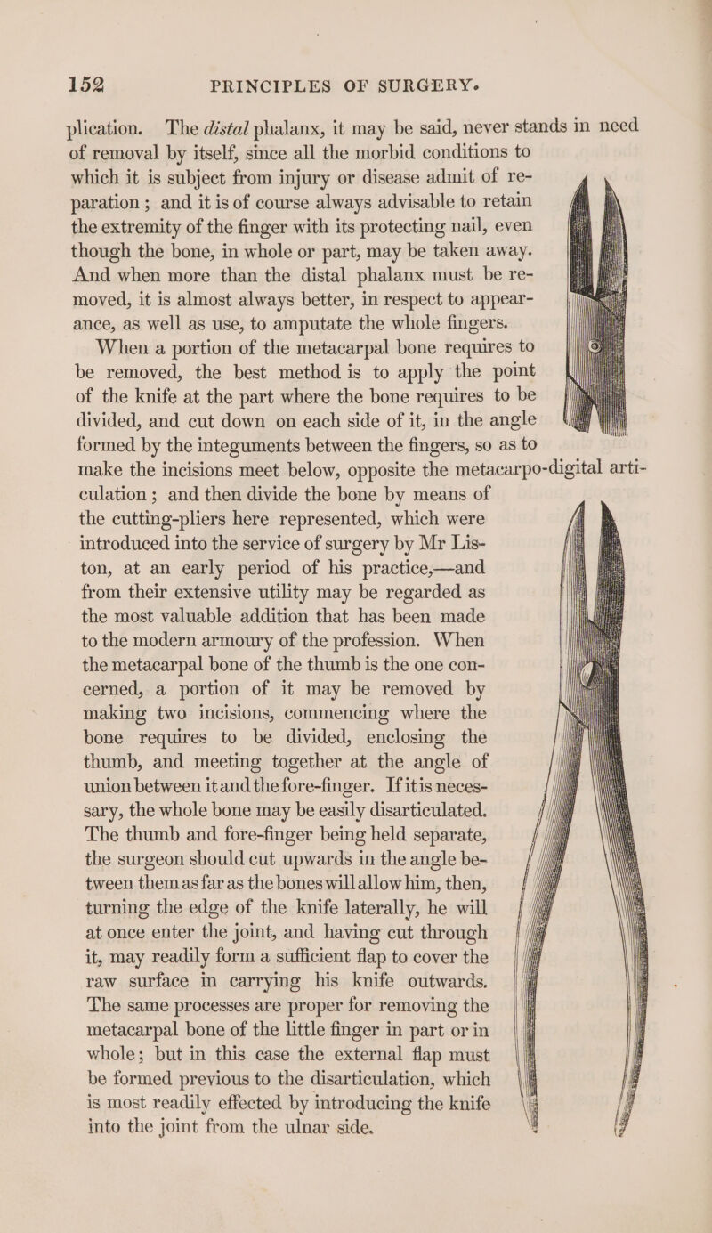 plication. The distal phalanx, it may be said, never stands in need of removal by itself, since all the morbid conditions to which it is subject from injury or disease admit of re- paration ; and it is of course always advisable to retain the extremity of the finger with its protecting nail, even though the bone, in whole or part, may be taken away. And when more than the distal phalanx must be re- moved, it is almost always better, in respect to appear- ance, as well as use, to amputate the whole fingers. When a portion of the metacarpal bone requires to be removed, the best method is to apply the point of the knife at the part where the bone requires to be divided, and cut down on each side of it, in the angle formed by the integuments between the fingers, so as to make the incisions meet below, opposite the metacarpo-digital arti- culation ; and then divide the bone by means of the cutting-pliers here represented, which were introduced into the service of surgery by Mr Lis- ton, at an early period of his practice,—and from their extensive utility may be regarded as the most valuable addition that has been made to the modern armoury of the profession. When the metacarpal bone of the thumb is the one con- cerned, a portion of it may be removed by making two incisions, commencing where the bone requires to be divided, enclosing the thumb, and meeting together at the angle of union between itand the fore-finger. Ifitis neces- sary, the whole bone may be easily disarticulated. The thumb and fore-finger being held separate, the surgeon should cut upwards in the angle be- tween them as far as the bones will allow him, then, turning the edge of the knife laterally, he will at once enter the joint, and having cut through it, may readily form a sufficient flap to cover the raw surface in carrying his knife outwards. The same processes are proper for removing the metacarpal bone of the little finger in part or in whole; but in this case the external flap must be formed previous to the disarticulation, which is most readily effected by introducing the knife into the joint from the ulnar side.