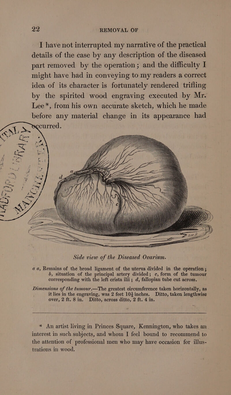 I have not interrupted my narrative of the practical details of the case by any description of the diseased part removed by the operation; and the difficulty I might have had in conveying to my readers a correct idea of its character is fortunately rendered trifling by the spirited wood engraving executed by Mr. Lee*, from his own accurate sketch, which he made before any material change in its appearance had curred. Side view of the Diseased Ovarium. aa, Remains of the broad ligament of the uterus divided in the operation ; b, situation of the principal artery divided; c, form of the tumour corresponding with the left crista ilii; d, fallopian tube cut across. Dimensions of the tumour.—The greatest circumference taken horizontally, as it lies in the engraving, was 2 feet 103inches. Ditto, taken lengthwise over, 2 ft. 8 in. Ditto, across ditto, 2 ft. 4 in. * An artist living in Princes Square, Kennington, who takes an interest in such subjects, and whom I feel bound to recommend to the attention of professional men who may have occasion for illus- trations i wood.