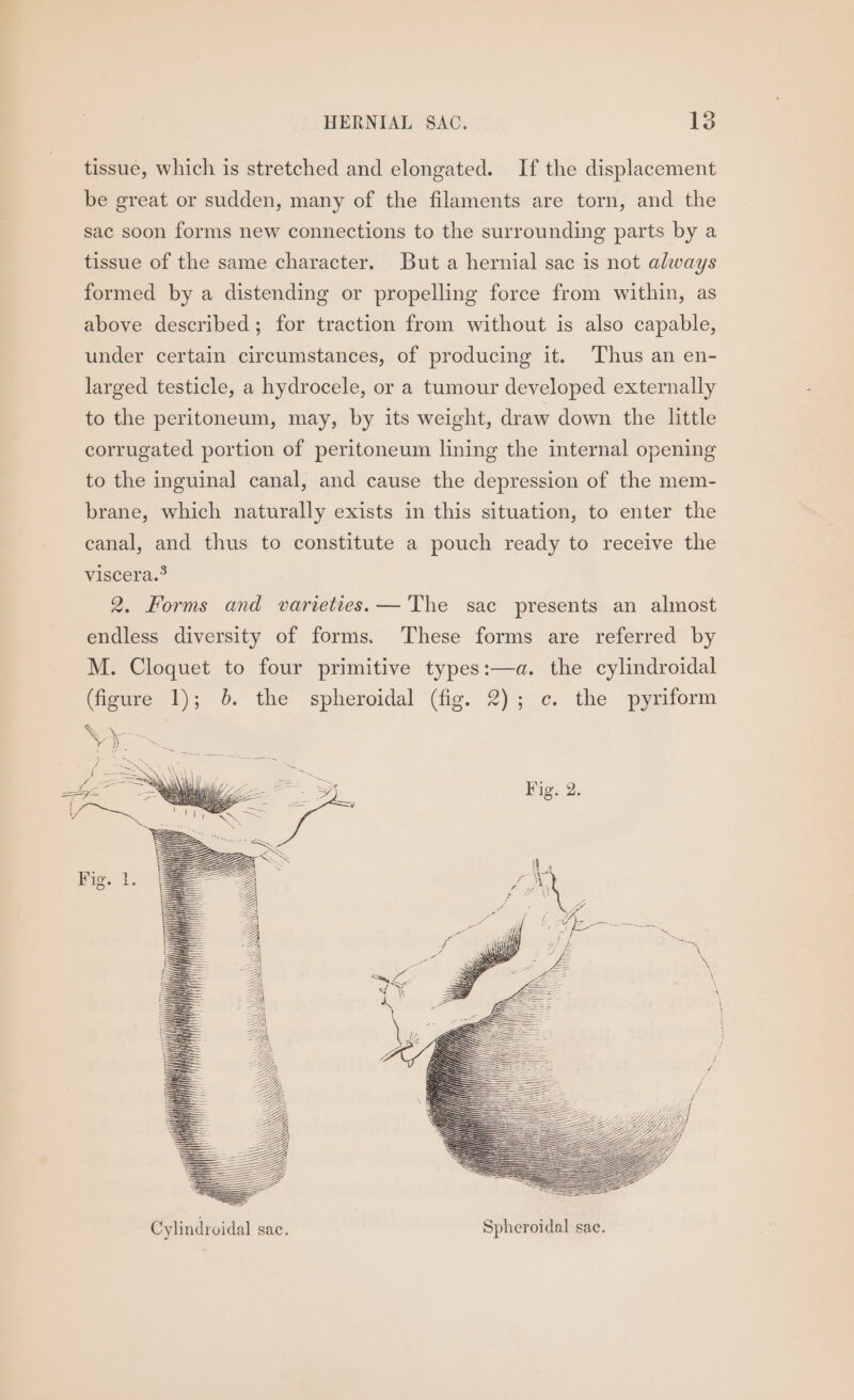 tissue, which is stretched and elongated. If the displacement be great or sudden, many of the filaments are torn, and the sac soon forms new connections to the surrounding parts by a tissue of the same character. But a hernial sac is not always formed by a distending or propelling force from within, as above described; for traction from without is also capable, under certain circumstances, of producing it. ‘Thus an en- larged testicle, a hydrocele, or a tumour developed externally to the peritoneum, may, by its weight, draw down the little corrugated portion of peritoneum lining the internal opening to the inguinal canal, and cause the depression of the mem- brane, which naturally exists in this situation, to enter the canal, and thus to constitute a pouch ready to receive the viscera.° 2. Forms and varieties. — The sac presents an almost endless diversity of forms. These forms are referred by M. Cloquet to four primitive types:—a. the cylindroidal (figure 1); 6. the spheroidal (fig. 2); ¢. the pyriform 2 = EB are SH =eQdy\ \ \\\ Cylindroidal sac. Spheroidal sac.