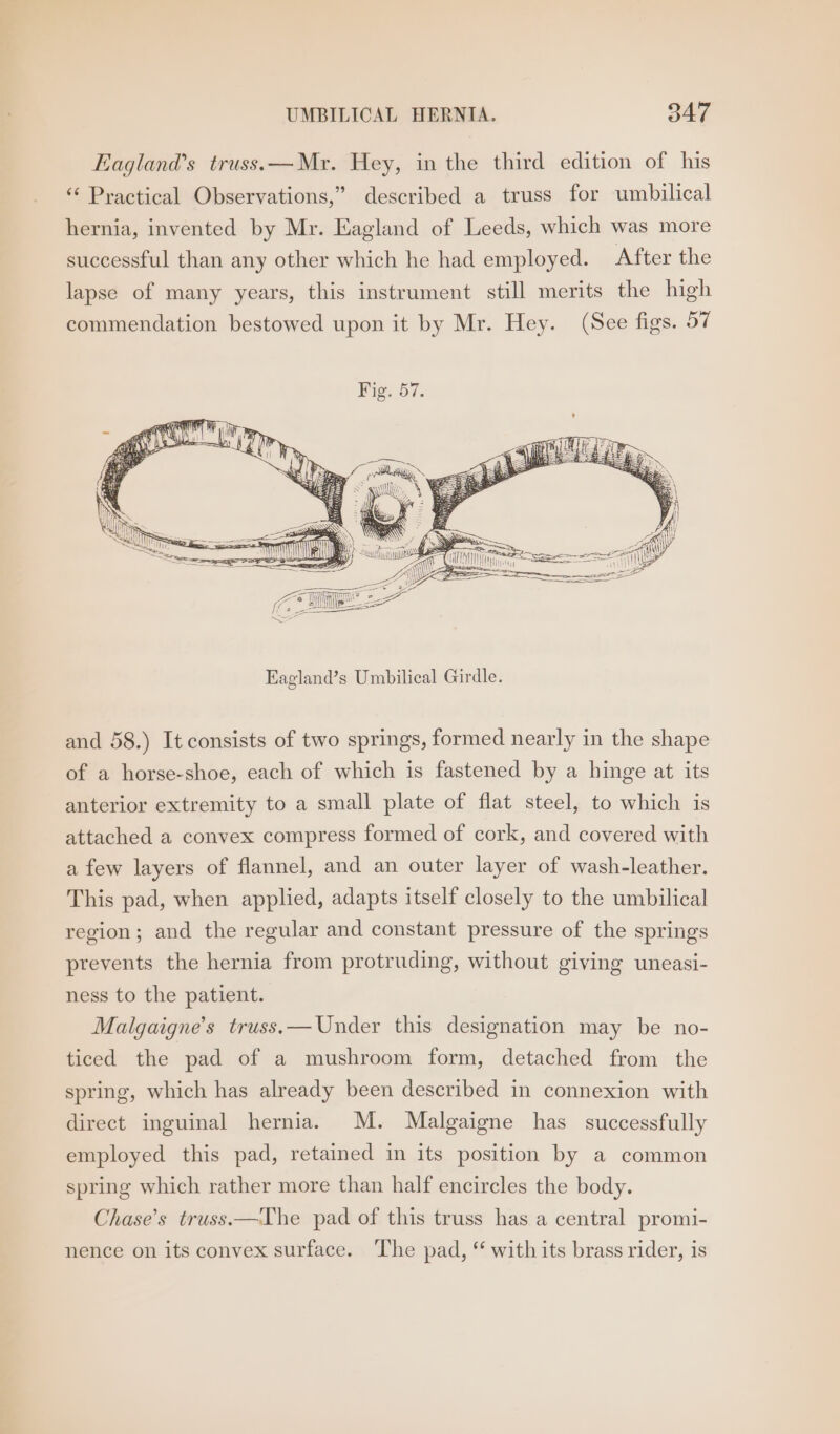 Eagland’s truss. — Mr. Hey, in the third edition of his ‘‘ Practical Observations,” described a truss for umbilical hernia, invented by Mr. Eagland of Leeds, which was more successful than any other which he had employed. After the lapse of many years, this instrument still merits the high commendation bestowed upon it by Mr. Hey. (See figs. 57 TR AN? TMI ine cee Eagland’s Umbilical Girdle. and 58.) It consists of two springs, formed nearly in the shape of a horse-shoe, each of which is fastened by a hinge at its anterior extremity to a small plate of flat steel, to which is attached a convex compress formed of cork, and covered with a few layers of flannel, and an outer layer of wash-leather. This pad, when applied, adapts itself closely to the umbilical region; and the regular and constant pressure of the springs prevents the hernia from protruding, without giving uneasi- ness to the patient. Malgaigne’s truss.— Under this designation may be no- ticed the pad of a mushroom form, detached from the spring, which has already been described in connexion with direct inguinal hernia. M. Malgaigne has successfully employed this pad, retained in its position by a common spring which rather more than half encircles the body. Chase’s truss.—The pad of this truss has a central promi- nence on its convex surface. ‘The pad, “ with its brass rider, is