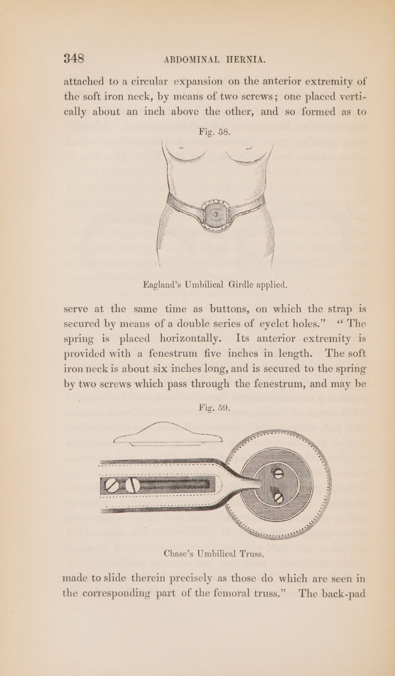 attached to a circular expansion on the anterior extremity of the soft iron neck, by means of two screws; one placed verti- cally about an inch above the other, and so formed as to WM), i} UUMT>., ~ Myf a Kagland’s Umbilical Girdle applied. serve at the same time as buttons, on which the strap is secured by means of a double series of eyelet holes.” ‘* The spring is placed horizontally. Its anterior extremity is provided with a fenestrum five inches in length. ‘The soft iron neck is about six inches long, and is secured to the spring by two screws which pass through the fenestrum, and may be Fig. 59. tras! made to slide therein precisely as those do which are seen in The back-pad the corresponding part of the femoral truss.”