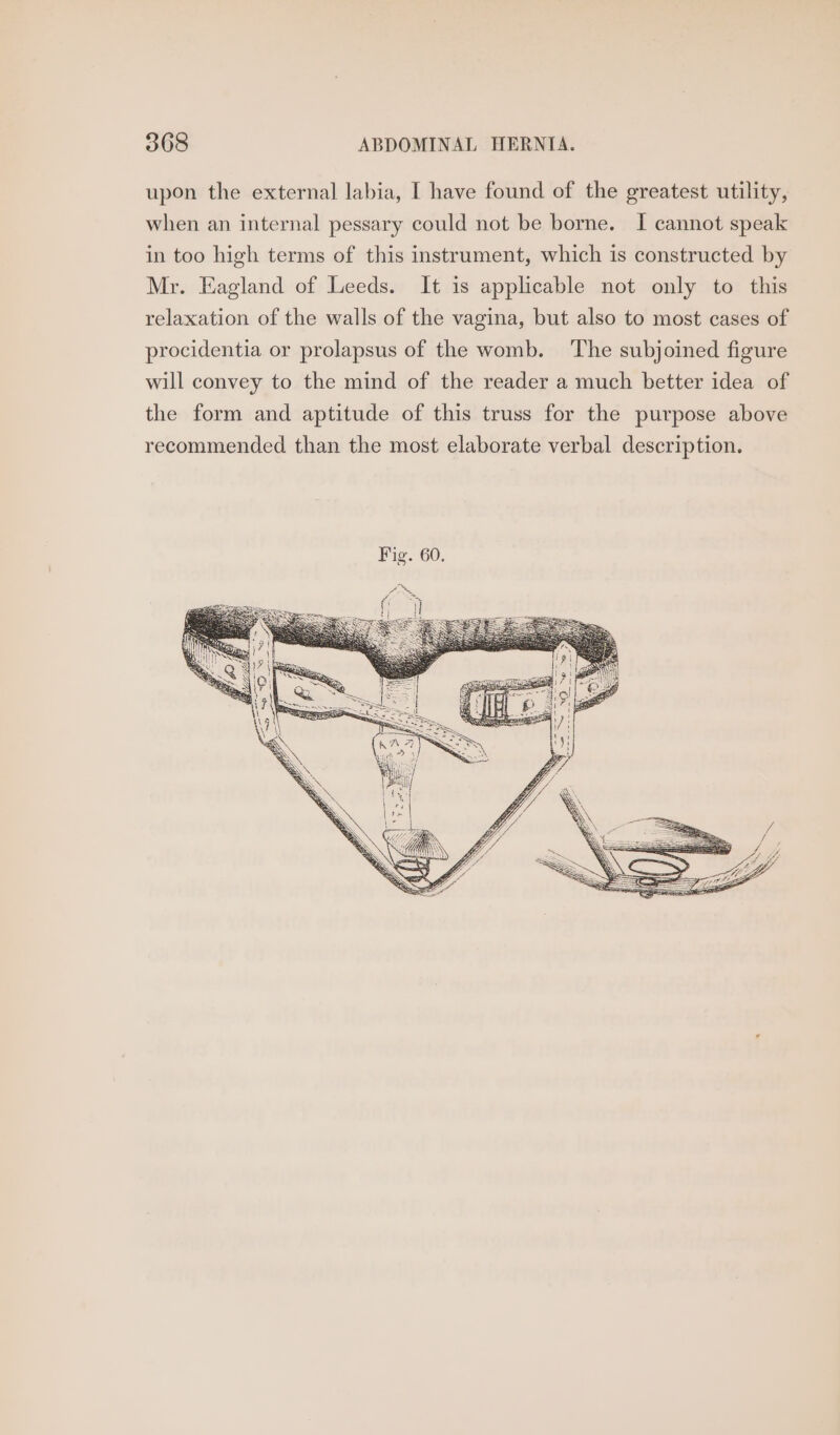 upon the external labia, I have found of the greatest utility, when an internal pessary could not be borne. I cannot speak in too high terms of this instrument, which is constructed by Mr. Eagland of Leeds. It is applicable not only to this relaxation of the walls of the vagina, but also to most cases of procidentia or prolapsus of the womb. ‘The subjoined figure will convey to the mind of the reader a much better idea of the form and aptitude of this truss for the purpose above recommended than the most elaborate verbal description.