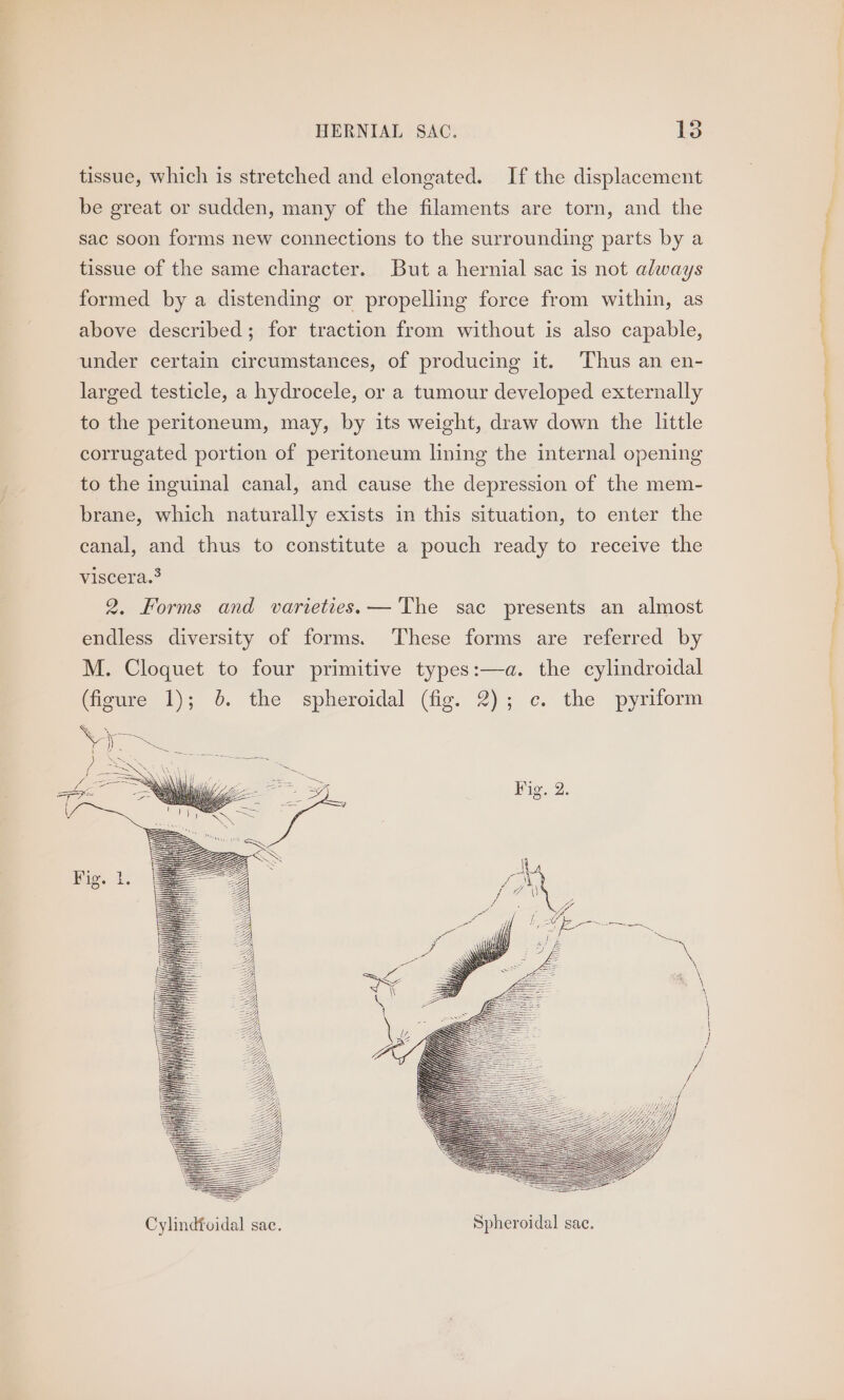 tissue, which is stretched and elongated. If the displacement be great or sudden, many of the filaments are torn, and the sac soon forms new connections to the surrounding parts by a tissue of the same character. But a hernial sac is not always formed by a distending or propelling force from within, as above described; for traction from without is also capable, under certain circumstances, of producing it. ‘Thus an en- larged testicle, a hydrocele, or a tumour developed externally to the peritoneum, may, by its weight, draw down the little corrugated portion of peritoneum lining the internal opening to the inguinal canal, and cause the depression of the mem- brane, which naturally exists in this situation, to enter the canal, and thus to constitute a pouch ready to receive the viscera.° 2. Forms and varieties. — The sac presents an almost endless diversity of forms. ‘These forms are referred by M. Cloquet to four primitive types:—a. the cylindroidal Gigure/f); 0. the spheroidal (fig. 2); ¢..the pyriform So oe Pe ae