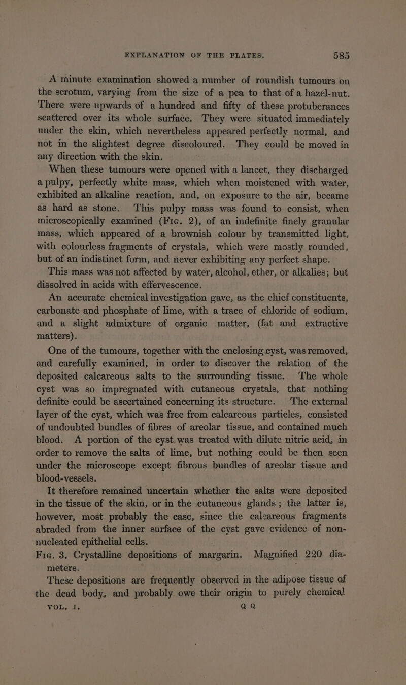 A minute examination showed a number of roundish tumours on the scrotum, varying from the size of a pea to that of a hazel-nut. There were upwards of a hundred and fifty of these protuberances scattered over its whole surface. They were situated immediately under the skin, which nevertheless appeared perfectly normal, and not in the slightest degree discoloured. They could be moved in any direction with the skin. | When these tumours were opened with a lancet, they discharged a pulpy, perfectly white mass, which when moistened with water, exhibited an alkaline reaction, and, on exposure to the air, became as hard as stone. This pulpy mass was found to consist, when microscopically examined (Fie. 2), of an indefinite finely granular mass, which appeared of a brownish colour by transmitted light, with colourless fragments of crystals, which were mostly rounded, but of an indistinct form, and never exhibiting any perfect shape. This mass was not affected by water, alcohol, ether, or alkalies; but dissolved in acids with effervescence. An accurate chemical investigation gave, as the chief constituents, carbonate and phosphate of lime, with a trace of chloride of sodium, and a slight admixture of organic matter, (fat and extractive matters). One of the tumours, together with the enclosing.cyst, was removed, and carefully examined, in order to discover the relation of the deposited calcareous salts to the surrounding tissue. The whole cyst was so impregnated with cutaneous crystals, that nothing definite could be ascertained concerning its structure. The external layer of the cyst, which was free from calcareous particles, consisted of undoubted bundles of fibres of areolar tissue, and contained much blood. A portion of the cyst.was treated with dilute nitric acid; in order to remove the salts of lime, but nothing could be then seen under the microscope except fibrous bundles of areolar tissue and blood-vessels. It therefore remained uncertain whether the salts were deposited in the tissue of the skin, or in the cutaneous glands; the latter is, however, most probably the case, since the calzareous fragments abraded from the inner surface of the cyst gave evidence of non- nucleated epithelial cells. Fie. 3. Crystalline depositions of margarin. Magnified 220 dia- meters. | These depositions are frequently observed in the adipose tissue of the dead body, and probably owe their origin to purely chemical VOL, I, aa
