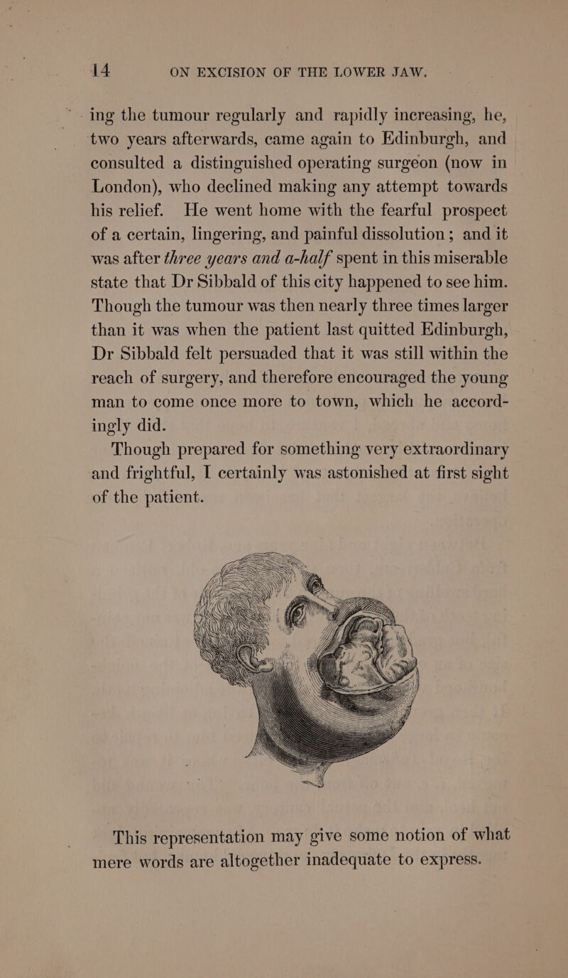 two years afterwards, came again to Edinburgh, and consulted a distinguished operating surgeon (now in London), who declined making any attempt towards his relief. He went home with the fearful prospect of a certain, lingering, and painful dissolution ; and it was after three years and a-half spent in this miserable state that Dr Sibbald of this city happened to see him. Though the tumour was then nearly three times larger than it was when the patient last quitted Edinburgh, Dr Sibbald felt persuaded that it was still within the reach of surgery, and therefore encouraged the young man to come once more to town, which he accord- ingly did. Though prepared for something very extraordinary and frightful, [ certainly was astonished at first sight of the patient. This representation may give some notion of what mere words are altogether inadequate to express.