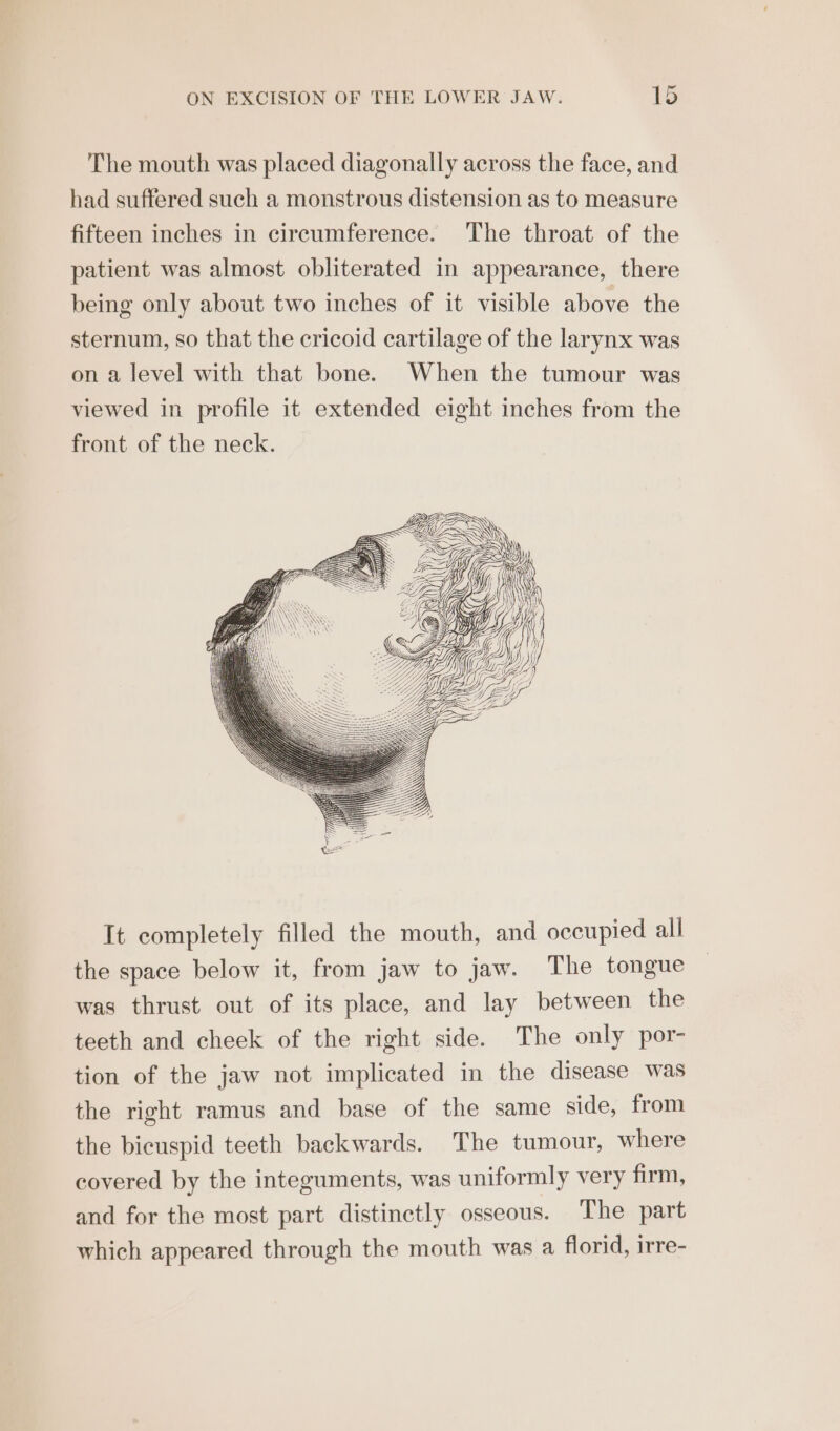 The mouth was placed diagonally across the face, and had suffered such a monstrous distension as to measure fifteen inches in circumference. The throat of the patient was almost obliterated in appearance, there being only about two inches of it visible above the sternum, so that the cricoid cartilage of the larynx was on a level with that bone. When the tumour was viewed in profile it extended eight inches from the front of the neck. It completely filled the mouth, and occupied all the space below it, from jaw to jaw. The tongue was thrust out of its place, and lay between the teeth and cheek of the right side. The only por- tion of the jaw not implicated in the disease was the right ramus and base of the same side, from the bicuspid teeth backwards. The tumour, where covered by the integuments, was uniformly very firm, and for the most part distinctly osseous. The part which appeared through the mouth was a florid, irre-