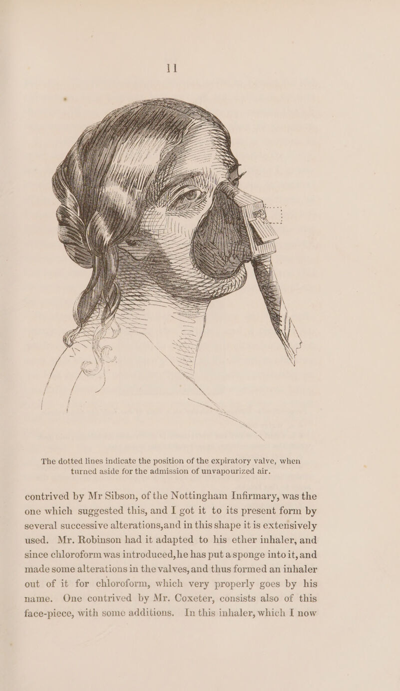 The dotted lines indicate the position of the expiratory valve, when turned aside for the admission of unvapourized air. contrived by Mr Sibson, of the Nottingham Infirmary, was the one which suggested this, and I got it to its present form by several successive alterations,and in this shape it is extensively used. Mr. Robinson had it adapted to his ether inhaler, and since chloroform was introduced, he has put asponge into it, and made some alterations in the valves, and thus formed an inhaler out of it for chloroform, which very properly goes by his name. One contrived by Mr. Coxeter, consists also of this face-piece, with some additions. In this inhaler, which I now