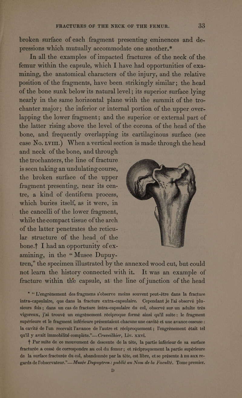 broken surface of each fragment presenting eminences and de- pressions which mutually accommodate one another.* In all the examples of impacted fractures of the neck of the femur within the capsule, which I have had opportunities of exa- mining, the anatomical characters of the injury, and the relative position of the fragments, have been strikingly similar; the head of the bone sunk below its natural level; its superior surface lying nearly in the same horizontal plane with the summit of the tro- chanter major; the inferior or internal portion of the upper over- lapping the lower fragment; and the superior or external part of the latter rising above the level of the corona of the head of the bone, and frequently overlapping its cartilaginous surface (see case No. rvi.) When a vertical section is made through the head and neck of the bone, and through the trochanters, the line of fracture is seen taking an undulating course, tre, a kind of dentiform process, which buries itself, as it were, in the cancelli of the lower fragment, while the compact tissue of the arch of the latter penetrates the reticu- lar structure of the head of the bone.f I had an opportunity of ex- amining, in the “ Musee Dupuy- tren,” the specimen illustrated by the annexed wood cut, but could not learn the history connected with it. It was an example of fracture within the capsule, at the line of junction of the head *“Trengrénement des fragmens s’observe moins souvent peut-étre dans la fracture intra-capsulaire, que dans la fracture extra-capsulaire. Cependant je l’ai observé plu- sieurs fois; dans un cas-de fracture intra-capsulaire du col, observé sur un adulte trés vigoreux, j’ai trouvé un engrénement réciproque formé ainsi quwil suite: le fragment supérieure et le fragment inférieure présentaient chacune une cavité et une avance osseuse : la cavité de lun recevait lavance de l’autre et réciproquement; l’engrénement était tel quwil y avait immobilité compléte.”— Cruveilhier, Liv. xxvi. t Par suite de ce mouvement de descente de la téte, la partie inférieur de sa surface fracturée a cessé de correspondre au col du femur; et réciproquement la partie supérieure de la surface fracturée du col, abandonnée par la téte, est libre, et se présente 4 nu aux re- gards de l’observateur.”— Musée Dupuytren: publié au Nom dela Faculté. Tome premier. D