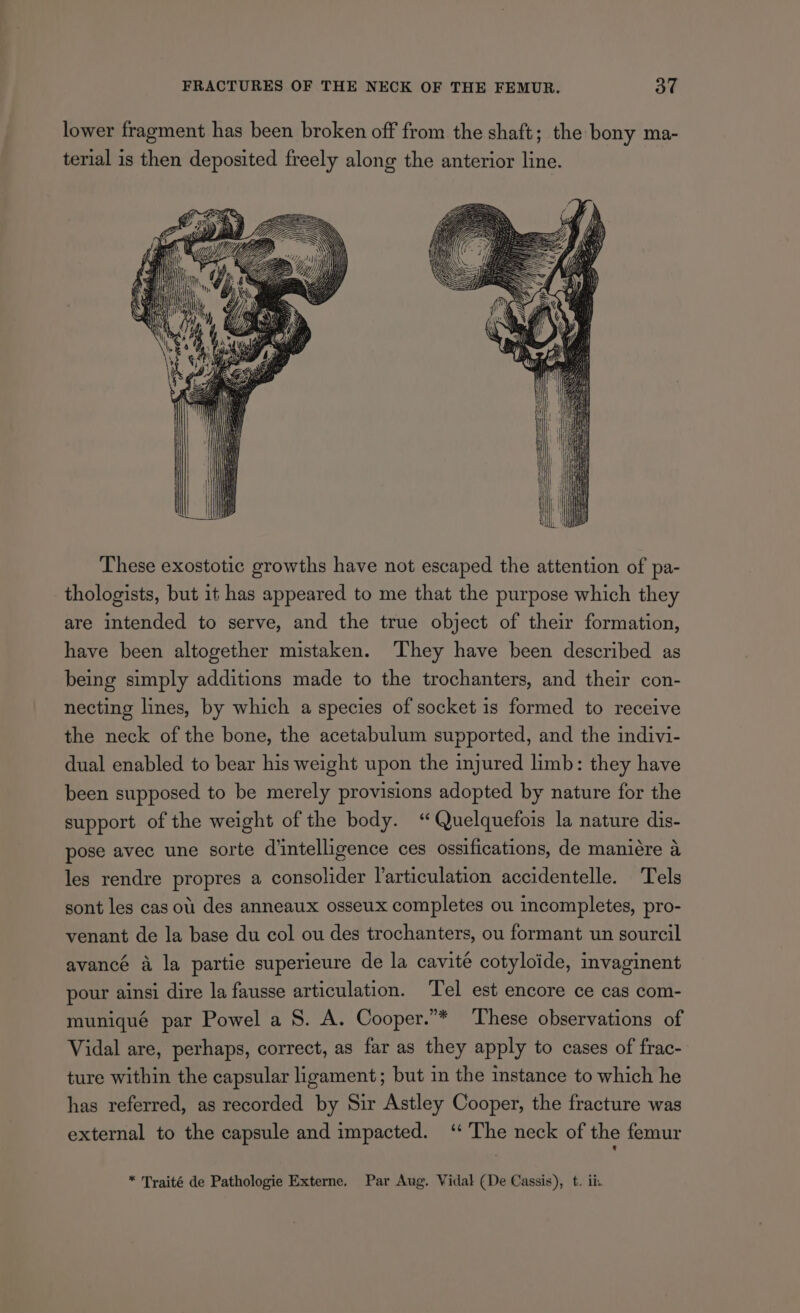 lower fragment has been broken off from the shaft; the bony ma- terial is then deposited freely along the anterior line. Ah These exostotic growths have not escaped the attention of pa- thologists, but it has appeared to me that the purpose which they are intended to serve, and the true object of their formation, have been altogether mistaken. ‘They have been described as being simply additions made to the trochanters, and their con- necting lines, by which a species of socket is formed to receive the neck of the bone, the acetabulum supported, and the indivi- dual enabled to bear his weight upon the injured limb: they have been supposed to be merely provisions adopted by nature for the support of the weight of the body. “Quelquefois la nature dis- pose avec une sorte d’intelligence ces ossifications, de maniére a les rendre propres a consolider l’articulation accidentelle. Tels sont les cas ol des anneaux osseux completes ou incompletes, pro- venant de la base du col ou des trochanters, ou formant un sourcil avancé a la partie superieure de la cavite cotyloide, invaginent pour ainsi dire la fausse articulation. Tel est encore ce cas com- muniqué par Powel a S. A. Cooper.”* These observations of Vidal are, perhaps, correct, as far as they apply to cases of frac- ture within the capsular ligament; but in the instance to which he has referred, as recorded by Sir Astley Cooper, the fracture was external to the capsule and impacted. ‘ The neck of the femur * Traité de Pathologie Externe, Par Aug. Vidal (De Cassis), t. ii.