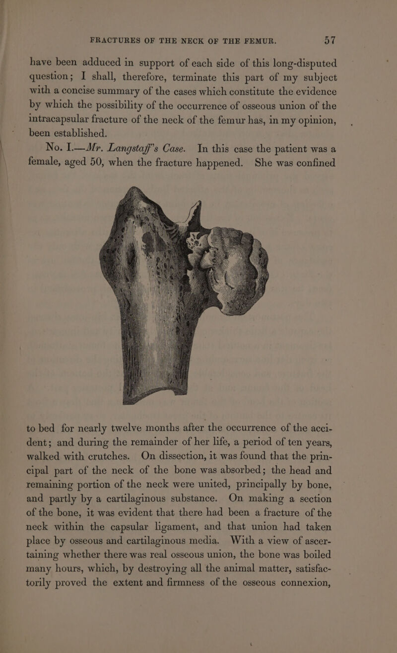 have been adduced in support of each side of this long-disputed question; I shall, therefore, terminate this part of my subject with a concise summary of the cases which constitute the evidence by which the possibility of the occurrence of osseous union of the intracapsular fracture of the neck of the femur has, in my opinion, been established. No. I.— Mr. Langstaff’s Case. In this case the patient was a female, aged 50, when the fracture happened. She was confined to bed for nearly twelve months after the occurrence of the acci- dent; and during the remainder of her life, a period of ten years, walked with crutches. On dissection, it was found that the prin- cipal part of the neck of the bone was absorbed; the head and remaining portion of the neck were united, principally by bone, and partly by a cartilaginous substance. On making a section of the bone, it was evident that there had been a fracture of the neck within the capsular ligament, and that union had taken place by osseous and cartilaginous media. With a view of ascer- taining whether there was real osseous union, the bone was boiled many hours, which, by destroying all the animal matter, satisfac- torily proved the extent and firmness of the osseous connexion,