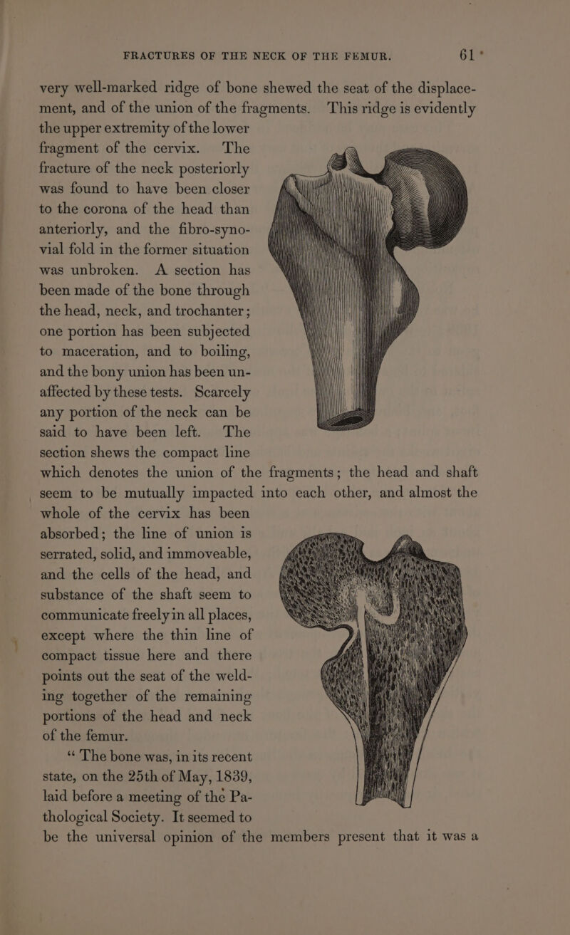very well-marked ridge of bone shewed the seat of the displace- ment, and of the union of the fragments. This ridge is evidently the upper extremity of the lower fragment of the cervix. The fracture of the neck posteriorly was found to have been closer to the corona of the head than anteriorly, and the fibro-syno- vial fold in the former situation was unbroken. A section has been made of the bone through the head, neck, and trochanter; one portion has been subjected to maceration, and to boiling, and the bony union has been un- affected by these tests. Scarcely any portion of the neck can be said to have been left. The section shews the compact line which denotes the union of the fragments; the head and shaft seem to be mutually impacted into each other, and almost the whole of the cervix has been absorbed; the line of union 1s serrated, solid, and immoveable, and the cells of the head, and substance of the shaft seem to communicate freely in all places, except where the thin line of compact tissue here and there points out the seat of the weld- ing together of the remaining portions of the head and neck of the femur. ‘“‘ The bone was, in its recent state, on the 25th of May, 1839, laid before a meeting of the Pa- thological Society. It seemed to be the universal opinion of the members present that it was a