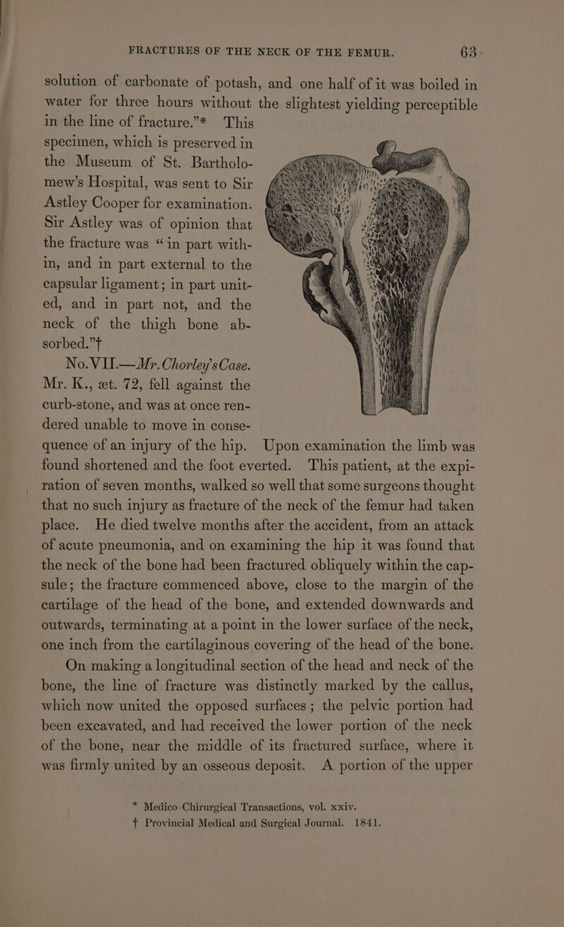 solution of carbonate of potash, and one half of it was boiled in water for three hours without the slightest yielding perceptible in the line of fracture.”* This specimen, which is preserved in the Museum of St. Bartholo- mew’s Hospital, was sent to Sir Astley Cooper for examination. Sir Astley was of opinion that the fracture was “in part with- in, and in part external to the capsular ligament; in part unit- ed, and in part not, and the neck of the thigh bone ab- sorbed.”f No. VU.— Mr. Chorley’s Case. Mr. K., et. 72, fell against the curb-stone, and was at once ren- dered unable to move in conse- quence of an injury of the hip. Upon examination the limb was found shortened and the foot everted. This patient, at the expi- ration of seven months, walked so well that some surgeons thought that no such injury as fracture of the neck of the femur had taken place. He died twelve months after the accident, from an attack of acute pneumonia, and on examining the hip it was found that the neck of the bone had been fractured obliquely within the cap- sule; the fracture commenced above, close to the margin of the cartilage of the head of the bone, and extended downwards and outwards, terminating at a point in the lower surface of the neck, one inch from the cartilaginous covering of the head of the bone. On making a longitudinal section of the head and neck of the bone, the line of fracture was distinctly marked by the callus, which now united the opposed surfaces ; the pelvic portion had been excavated, and had received the lower portion of the neck of the bone, near the middle of its fractured surface, where it was firmly united by an osseous deposit. A portion of the upper * Medico-Chirurgical Transactions, vol. xxiv. + Provincial Medical and Surgical Journal. 1841.