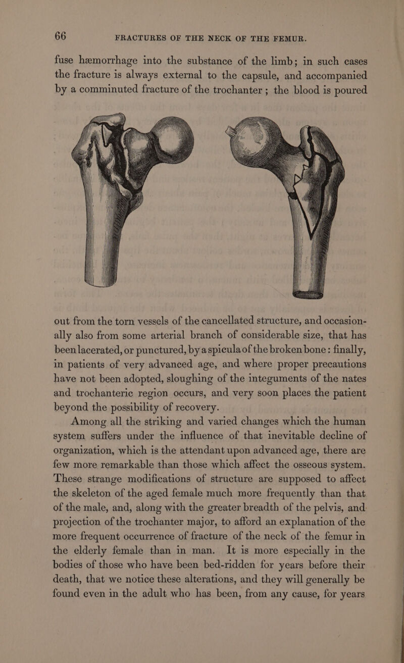 fuse hemorrhage into the substance of the limb; in such cases the fracture is always external to the capsule, and accompanied by a comminuted fracture of the trochanter ; the blood is poured out from the torn vessels of the cancellated structure, and occasion- ally also from some arterial branch of considerable size, that has been lacerated, or punctured, by aspicula of the broken bone: finally, in patients of very advanced age, and where proper precautions have not been adopted, sloughing of the integuments of the nates and trochanteric region occurs, and very soon places the patient beyond the possibility of recovery. Among all the striking and varied changes which the human system suffers under the influence of that inevitable decline of organization, which is the attendant upon advanced age, there are few more remarkable than those which affect the osseous system. These strange modifications of structure are supposed to affect the skeleton of the aged female much more frequently than that of the male, and, along with the greater breadth of the pelvis, and: projection of the trochanter major, to afford an explanation of the more frequent occurrence of fracture of the neck of the femur in the elderly female than in man. It is more especially in the bodies of those who have been bed-ridden for years before their death, that we notice these alterations, and they will generally be found even in the adult who has been, from any cause, for years