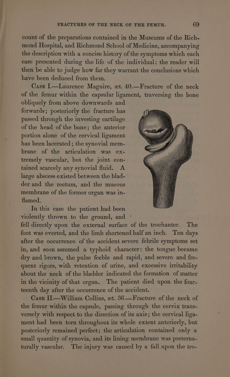 count of the preparations contained in the Museums of the Rich- mond Hospital, and Richmond School of Medicine, accompanying the description with a concise history of the symptoms which each case presented during the life of the individual: the reader will then be able to judge how far they warrant the conclusions which have been deduced from them. Case I.—Laurence Maguire, ext. 40.—Fracture of the neck of the femur within the capsular ligament, traversing the bone obliquely from above downwards and forwards; posteriorly the fracture has passed through the investing cartilage of the head of the bone; the anterior portion alone of the cervical ligament has been lacerated ; the synovial mem- brane of the articulation was ex- tremely vascular, but the joint con- tained scarcely any synovial fluid. A large abscess existed between the blad- der and the rectum, and the mucous membrane of the former organ was in- flamed. In this case the patient had been violently thrown to the ground, and fell directly upon the external surface of the trochanter. The foot was everted, and the limb shortened half an inch. Ten days after the occurrence of the accident severe febrile symptoms set in, and soon assumed a typhoid character: the tongue became dry and brown, the pulse feeble and rapid, and severe and fre- quent rigors, with retention of urine, and excessive irmitability about the neck of the bladder indicated the formation of matter in the vicinity of that organ. The patient died upon the four- teenth day after the occurrence of the accident. Cass I].—William Collins, «xt. 36.—Fracture of the neck of the femur within the capsule, passing through the cervix trans- versely with respect to the direction of its axis; the cervical liga- ment had been torn throughout its whole extent anteriorly, but posteriorly remained perfect; the articulation contained only a small quantity of synovia, and its lining membrane was preterna- turally vascular. The injury was caused by a fall-upon the tro-