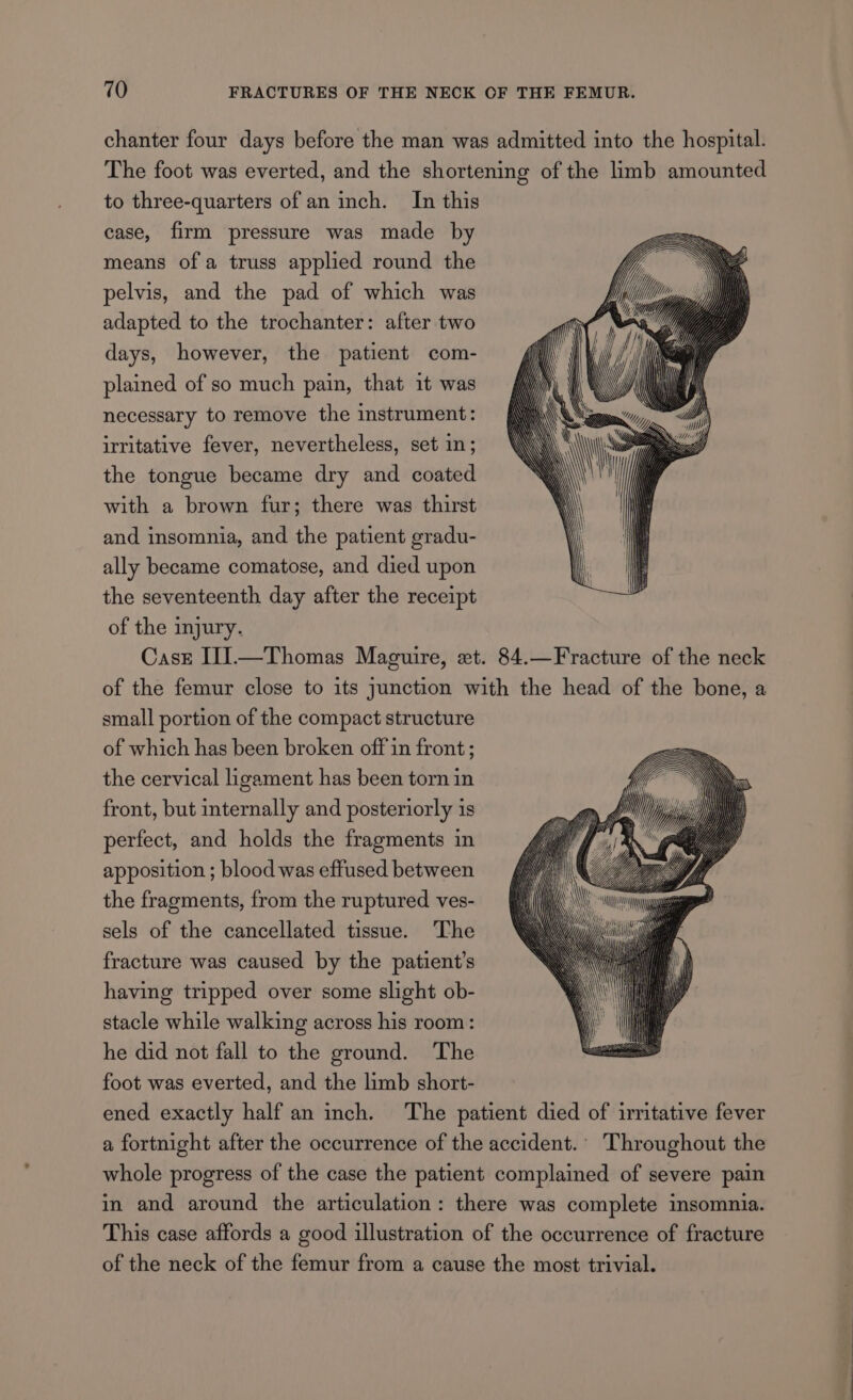 chanter four days before the man was admitted into the hospital. The foot was everted, and the shortening of the limb amounted to three-quarters of an inch. In this case, firm pressure was made by means ofa truss applied round the pelvis, and the pad of which was adapted to the trochanter: after two days, however, the patient com- plained of so much pain, that it was necessary to remove the instrument: irritative fever, nevertheless, set in; the tongue became dry and coated with a brown fur; there was thirst and insomnia, and the patient gradu- ally became comatose, and died upon the seventeenth day after the receipt of the injury. Cast I1I—Thomas Maguire, et. 84.—Fracture of the neck of the femur close to its junction with the head of the bone, a small portion of the compact structure of which has been broken off in front ; the cervical ligament has been torn in front, but internally and posteriorly is perfect, and holds the fragments in apposition ; blood was effused between the fragments, from the ruptured ves- sels of the cancellated tissue. The fracture was caused by the patient’s having tripped over some slight ob- stacle while walking across his room: he did not fall to the ground. The foot was everted, and the limb short- ened exactly half an inch. The patient died of irritative fever a fortnight after the occurrence of the accident.’ Throughout the whole progress of the case the patient complained of severe pain in and around the articulation: there was complete insomnia. This case affords a good illustration of the occurrence of fracture of the neck of the femur from a cause the most trivial.