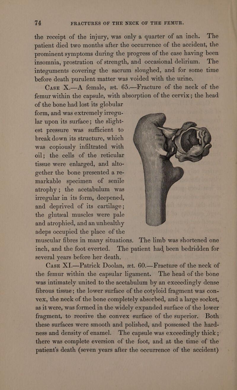 the receipt of the injury, was only a quarter of an inch. The patient died two months after the occurrence of the accident, the prominent symptoms during the progress of the case having been insomnia, prostration of strength, and occasional delirium. The integuments covering the sacrum sloughed, and for some time before death purulent matter was voided with the urine. Casz X.—A female, xt. 65.—Fracture of the neck of the femur within the capsule, with absorption of the cervix; the head of the bone had lost its globular form, and was extremely irregu- lar upon its surface; the slight- est pressure was sufficient to break down its structure, which was copiously infiltrated with oil; the cells of the reticular tissue were enlarged, and alto- gether the bone presented a re- markable specimen of senile atrophy ; the acetabulum was irregular in its form, deepened, and deprived of its cartilage; the glutewal muscles were pale and atrophied, and an unhealthy adeps occupied the place of the muscular fibres in many situations. The limb was shortened one inch, and the foot everted. The patient had been bedridden for several years before her death. Case XJ.—Patrick Doolan, et. 60.—Fracture of the neck of the femur within the capsular ligament. The head of the bone was intimately united to the acetabulum by an exceedingly dense fibrous tissue; the lower surface of the cotyloid fragment was con- vex, the neck of the bone completely absorbed, and a large socket, as it were, was formed in the widely expanded surface of the lower fragment, to receive the convex surface of the superior. Both these surfaces were smooth and polished, and possessed the hard- ness and density of enamel. The capsule was exceedingly thick ;: there was complete eversion of the foot, and at the time of the patient's death (seven years after the occurrence of the accident)