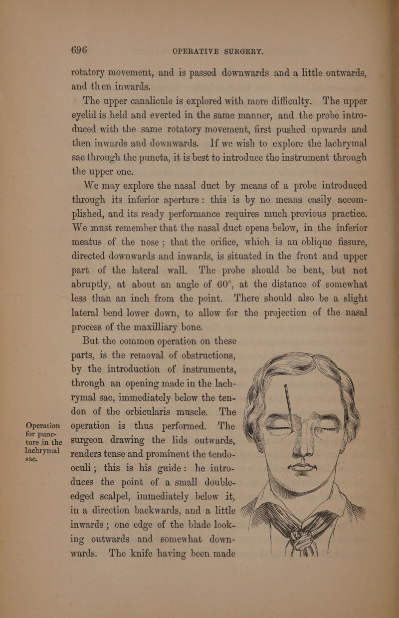Operation for punc- ture in the lachrymal Sac. 696 OPERATIVE SURGERY. rotatory movement, and is passed downwards and a little outwards, and then inwards. The upper canalicule is explored with more difficulty. The upper eyelid is held and everted in the same manner, and the probe intro- duced with the same rotatory movement, first pushed upwards and then inwards and downwards. If we wish to explore the lachrymal sac through the puncta, it is best to introduce the instrument through the upper one. We may explore the nasal duct by means of a probe introduced through its inferior aperture: this is by no means easily accom- plished, and its ready performance requires much previous practice. We must remember that the nasal duct opens below, in the inferior meatus of the nose; that the orifice, which is an oblique fissure, directed downwards and inwards, is situated in the front and upper part of the lateral wall. The probe should be bent, but not abruptly, at about an angle of 60°, at the distance of somewhat less than an inch from the point. ‘There should also be a slight lateral bend lower down, to allow for the projection of the nasal process of the maxilliary bone. But the common operation on these parts, is the removal of obstructions, by the introduction of instruments, through an opening made in the lach- rymal sac, immediately below the ten- don of the orbicularis muscle. The | operation is thus performed. The | surgeon drawing the lids outwards, “ renders tense and prominent the tendo- oculi; this is his guide: he intro- duces the point of a small double- edged scalpel, immediately below it, , in a direction backwards, and a little 7 i inwards ; one edge of the blade look- ing outwards and somewhat down- wards. ‘The knife having been made