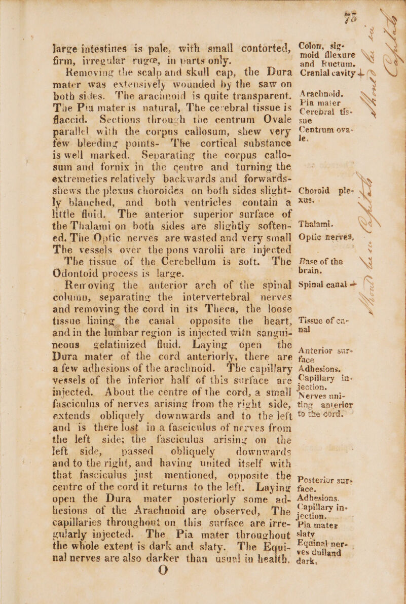 large intestines is pale, with small contorted, firm, irregular ruge, in parts only. Removing the scalp and skull cap, the Dura mater was extensively wounded by the saw on both sides. The aracimoid is quite transparent. Tue Pia materis natural, The cerebral tissue is flaccid. Sections through the centrum Ovale parallel with the corpus callosum, shew very few bleeding points- The cortical substance is well marked. Separating the corpus callo- sum and fornix in the centre and turning the extremeties relatively backwards and forwards- shews the plexus choroides on both sides slight- ly blanched, and both ventricles contain a little fluid. The anterior superior surface of the Thalami on both sides are slightly soften- ed. Tne Optic nerves are wasted and very sinall The vessels over the pons varolii are injected The tissue of the Cerebellum is soft. The Odontoid process is large. | | Removing the anterior arch of the spinal column, separating the intervertebral nerves and removing the cord in its Theca, the loose tissue lining the canal opposite the heart, and in the lumbar region is injected with sangu- neous gelatinized fluid. Laying open the a few achesions of the arachnoid. The capillary vessels of the inferior half of this surface are injected. About the centre of the cord, a small fasciculus of nerves arising from the right side, extends obliquely downwards and to the left aud is there lost in a fasciculus of nerves from the left side; the fasciculus arising on the left side, passed obliquely downwards and to the right, and having united itself with that fasciculus just mentioned, opposite the cevtre of the cord it returns to the left. Laying open the Dura mater posteriorly some ad- hesions of the Arachnoid are observed, The capillaries throughout on this surface are irre- gwarly injected. The Pia mater throughout the whole extent is dark and slaty. The Equi- nal nerves are also darker than usual in health, Color, sig- moid flexure and Kuctum. Cranial cavity 4. N Arachnoid. ~ § Pia mater ‘ Cerebral tis- sue Centrum ova- le. rk Wy Choroid ple- \ 4 XUS. - XN Thalami. VN Optic nerves, \ ‘X re Spinal canal + | ~~ &gt; SAS oa x Base of the brain. Tissue of ca- nal Anterior sire ‘ace Adhesions. Capillary in- jection. Nerves uni- ting anterier to the cord. Posterior sur face. Adhesions. Capillary in- Pia mater slaty Equinat ners ves dulland dark,
