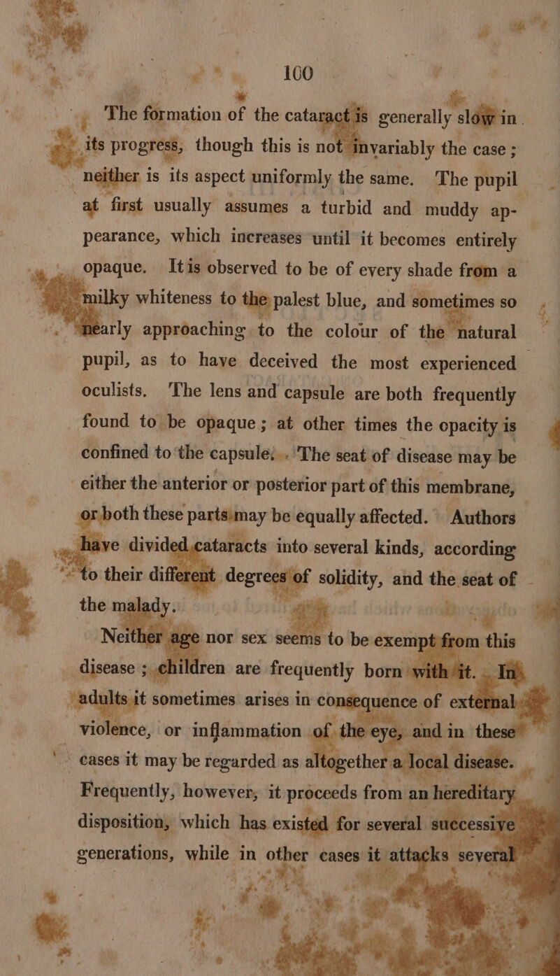 The Sroation o of the cata ract ‘ generally ibe in. its progress, though this is not it invariably the case ; sh ngffber i is “Ys spect uniformly the same. The pupil at ‘first usually assumes a turbid and muddy ap- pearance, which increases ‘until it becomes entirely _ opaque. Itis observed to be of every shade from a = : ~ milky whiteness to the palest blue, and some imes 80 nearly approaching. to the colour of the natural pupil, as to haye deceived the most experienced — oculists, The lens and capsule are both frequently found to be opaque; at other times the opacity is 4 confined to ‘the capsule...’ ‘The seat of disease may be -either the anterior or posterior part of this membrane, or both these partsimay be equally affected. Authors : ha ataracts into elie ee ger | Fidlanste, or inflammation . aes ca thesal® . cases it may be regarded as al wethe a local disease. Hrdguently; however; it proceeds from an hereditar L disposition, which has existed for several. ral success generations, while in other cases it.