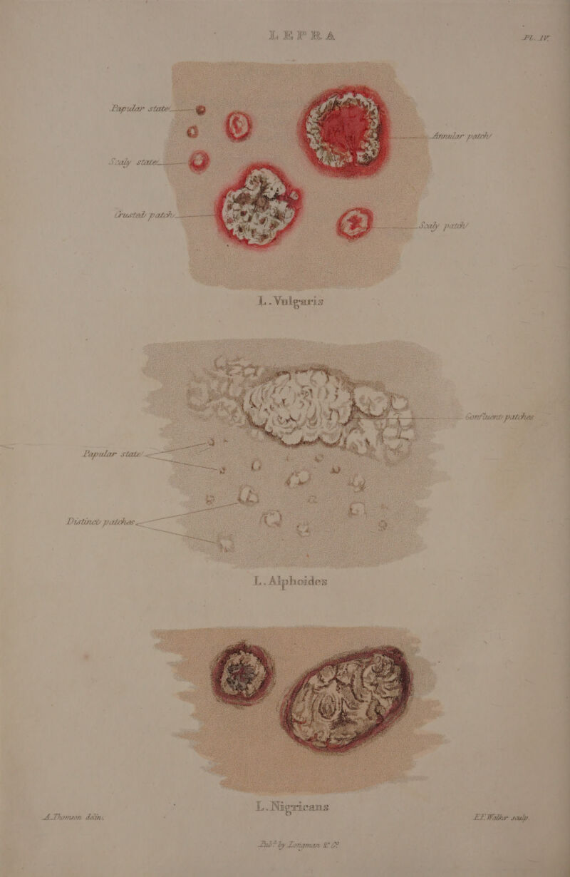 ; LEPRA PL Lapular state. Annular patch’ j { Crusted patchy | Soaly patch’ . ‘ : j a : ‘ 7 a { Distinct: patthes - { EE ee A.Thomson dealin. ‘ Lube by Lorigman LC?