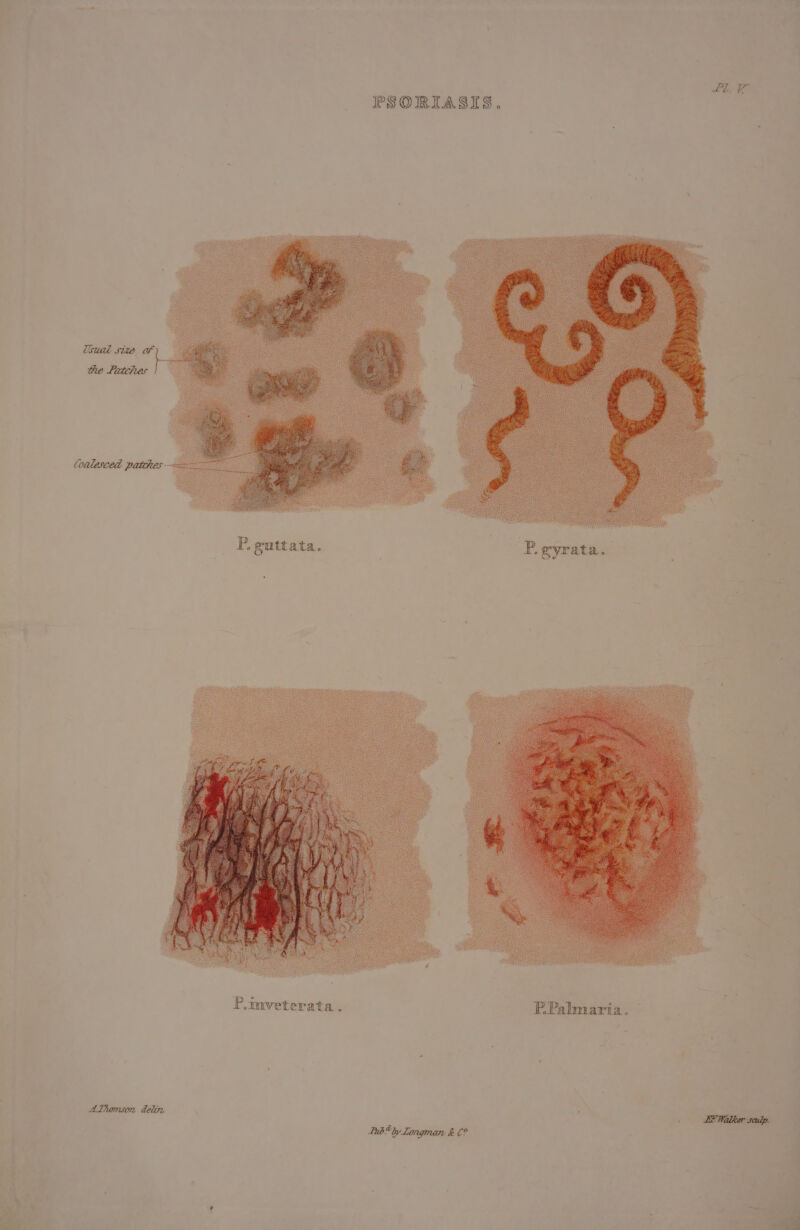 LL. PSORIASIS. “ss gutt ata. P, aria. P.tmveterata.