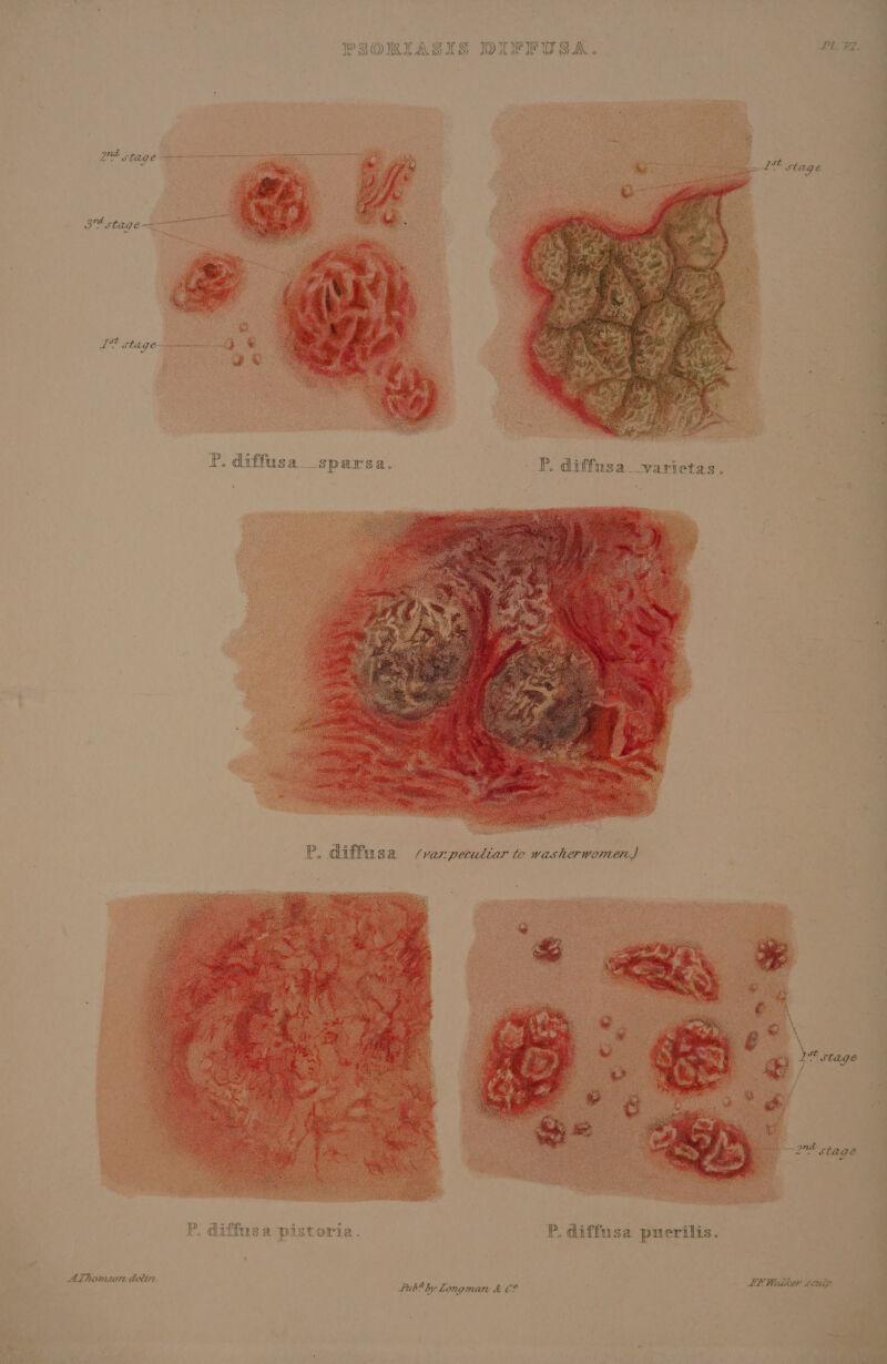 PSORIASIS DIFFUSA. P. diffusa sparsa. P. diffusa pistoria. | P. diffusa puerilis. AThomsor delin. Lub4by Longman &amp; C2