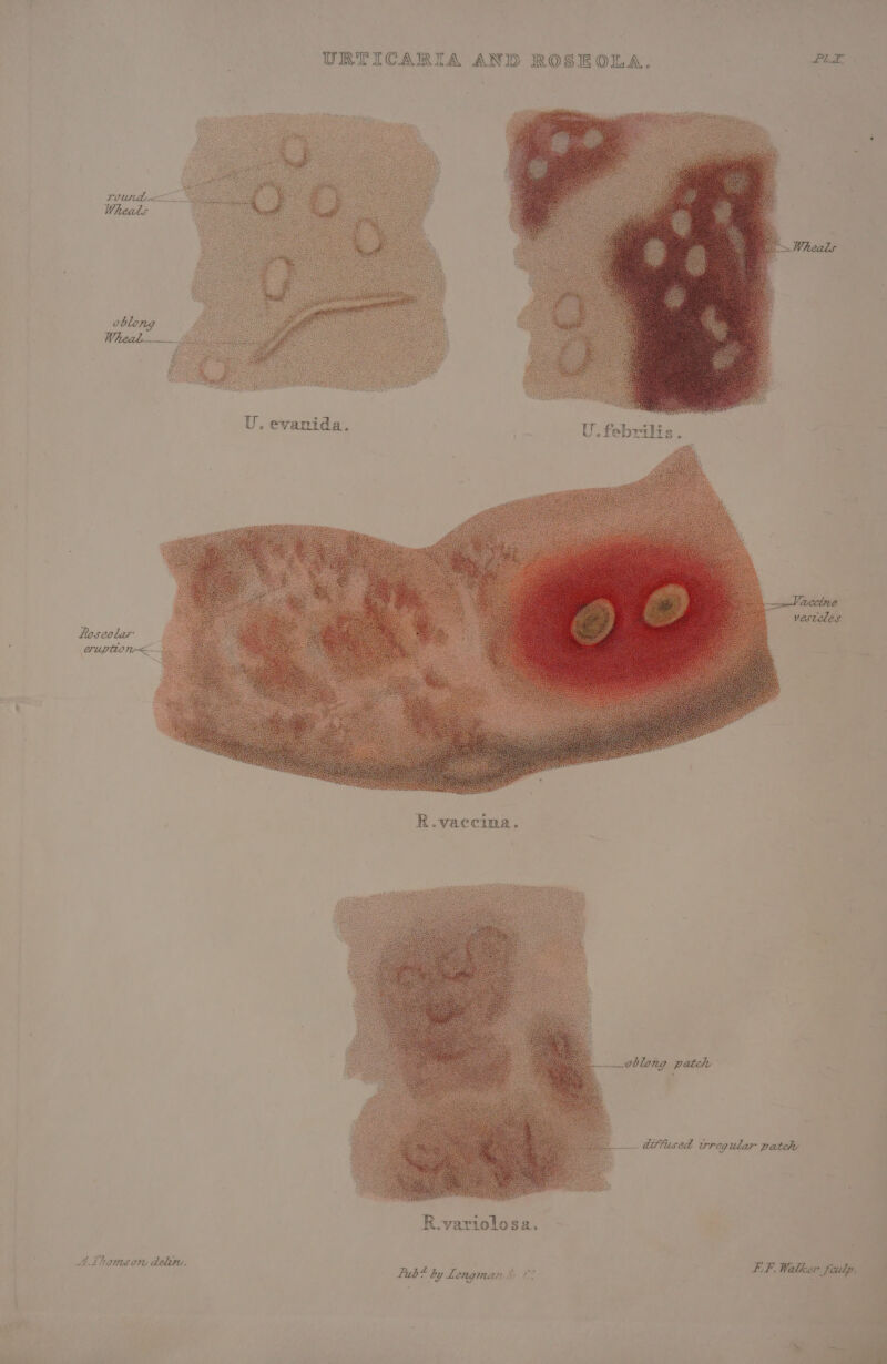 URTICARIA AND ROSEOLA. PLE 1 U. evanida. | U.febrilis. | ; R.variolosa. A thomson delim. Pub * by Lmagniane be 2 Fi of Walker Jeidp