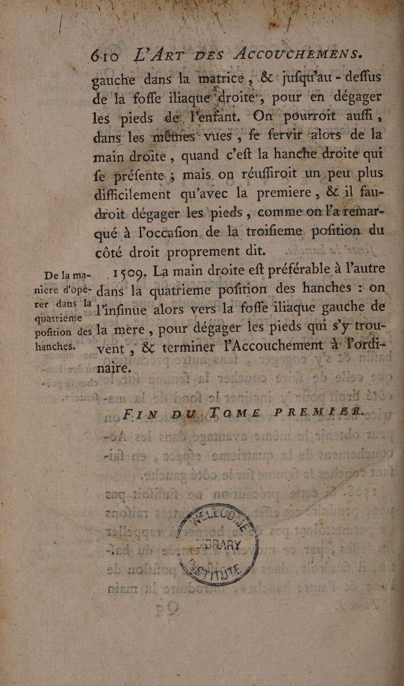 quatrieme auche dans la ma itricé , OC jufqu au = deffus de là foffe laqué droite, pour en dégager les pieds de K enfant. On pourroit aufh, dans les même vues , fe fervit alors de pp: Re: fe préfente ; mais on réufiroit un,peu plus difficilement qu'avec la premiere, &amp; al fau- droit dégager les pieds , comme:om a reinar- qué à loccañon. de la trorfieme, podition. du . côté droit proprement dit. \ qu) 1509. La main droite eft préférable à à EE f ++ “naire. … si &amp; vof DUT de eo héinèzol sshila: si AE Ti + ‘ den 7 ri + co .