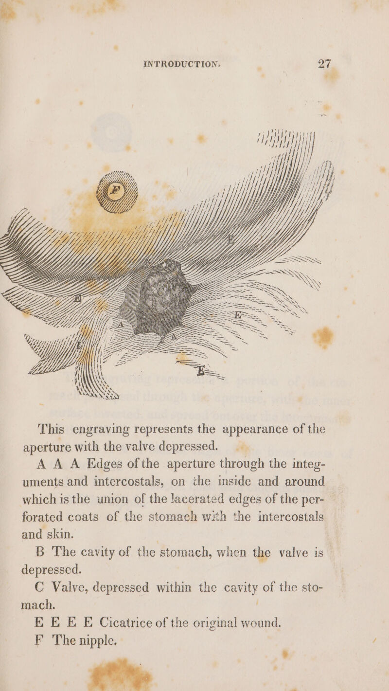 INTRODUCTION. ; 27 . oe a ° w er Pp Baris e ' . Ms i j Ht | pitt fii if HY See WE ea \ w/ Z a Spor he This engraving represents the appearance of the aperture with the valve depressed. A A A Edges of the aperture through the integ- uments and intercostals, on the inside and around which is the union of the lacerated edges of the per- forated coats of the stomach wh the intercostals and skin. | B The cavity of the stomach, when the valve is depressed. C Valve, depressed within the cavity of the sto- mach. EE E E Cicatrice of the original wound.