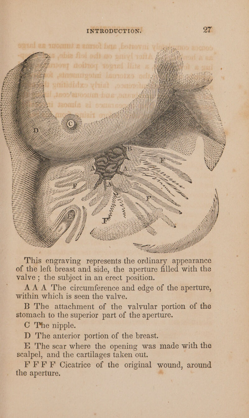 \ (9! \\ N Ke ee \ \ i \ it \ \ iit 74g AAAS AY \ NN ANY \ \ bed \\ S WS \ \ afl ail way) HY YY) \\ \\\ ANY \\ AY \ aN) ANY ENN ) \ \ A AYR NAN XA OR \\ eS Z == YO = Zz ) a= ZE- filly Wp Bos A 4) ta ty LG; This engraving represents the ordinary appearance of the left breast and side, the aperture filled with the valve ; the subject in an erect position. _ AAA The circumference and edge of the aperture, within which is seen the valve. B The attachment of the valvular portion of the stomach to the superior part of the aperture. C The nipple. D The anterior portion of the breast. FE, The scar where the opening was made with the scalpel, and the cartilages taken out. I’ FF F Cicatrice of the original wound, around hes the aperture.