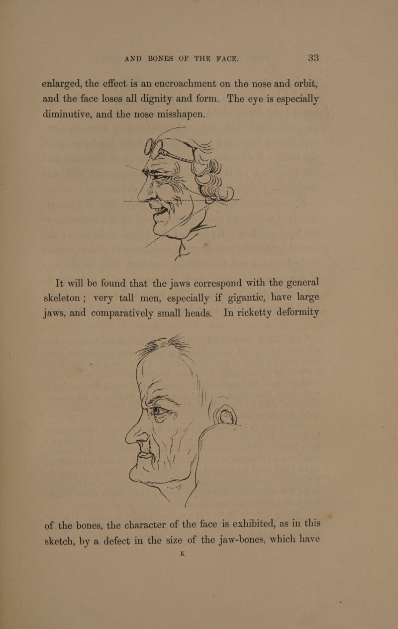 enlarged, the effect is an encroachment on the nose and orbit, and the face loses all dignity and form. The eye is especially diminutive, and the nose misshapen. It will be found that the jaws correspond with the general skeleton ; very tall men, especially if gigantic, have large jaws, and comparatively small heads. In ricketty deformity RSS 4 Z 3 ee 4 F \ of the bones, the character of the face is exhibited, as in this ' sketch, by a defect in the size of the jaw-bones, which have K