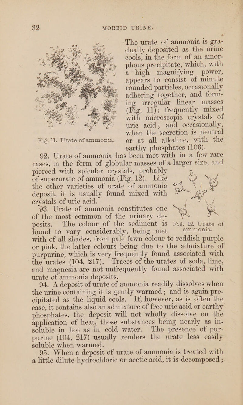 The urate of ammonia is gra- dually deposited as the urine cools, in the form of an amor- phous precipitate, which, with a high magnifying power, appears to consist of minute rounded particles, occasionally adhering together, and form- ing irregular linear masses (Fig. 11); frequently mixed with microscopic crystals of uric acid; and occasionally, when the secretion is neutral Fig.11. Urate of ammonia. or at all alkaline, with the earthy phosphates (106). 92. Urate of ammonia has been met with in a few rare cases, in the form of globular masses of a larger size, and pierced with spicular crystals, probably q of superurate of ammonia (Fig. 12). Like Of the other varieties of urate of ammonia Sp) FD) deposit, it is usually found mixed with &amp; Le crystals of uric acid. | LE | 93. Urate of ammonia constitutes one est an of the most common of the urinary de- FS posits. The colour of the sediment is Fig. 12. Urate of found to vary considerably, being met ammonia. with of all shades, from pale fawn colour to reddish purple or pink, the latter colours being due to the admixture of purpurine, which is very frequently found associated with the urates (104, 217). Traces of the urates of soda, lime, and magnesia are not unfrequently found associated with urate of ammonia deposits. 94. A deposit of urate of ammonia readily dissolves when the urine containing it is gently warmed ; and is again pre- cipitated as the liquid cools. If, however, as is often the case, it contains also an admixture of free uric acid or earthy phosphates, the deposit will not wholly dissolve on the application of heat, those substances being nearly as in- soluble in hot as in cold water. The presence of pur- purine (104, 217) usually renders the urate less easily soluble when warmed. 95. When a deposit of urate of ammonia is treated with a little dilute hydrochloric or acetic acid, it is decomposed ;