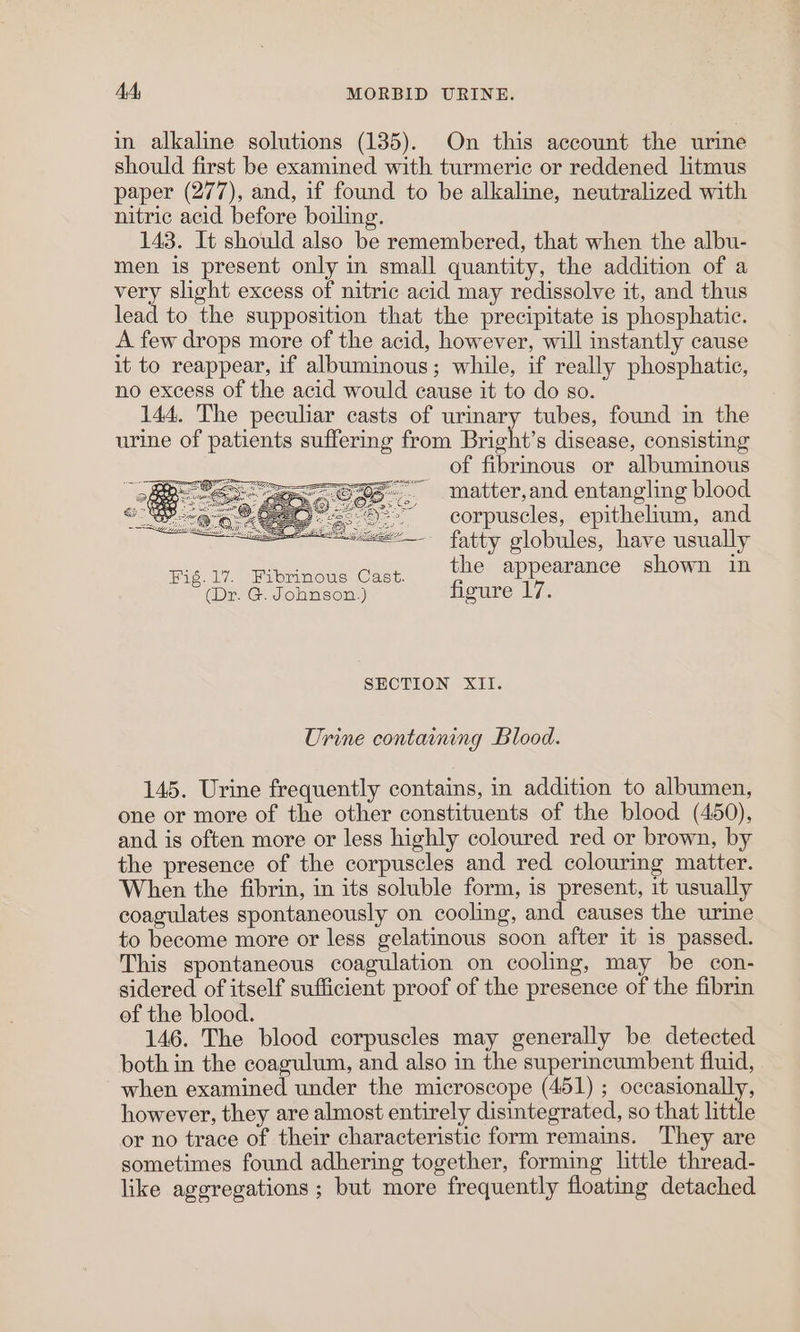 in alkaline solutions (135). On this account the urine should first be examined with turmeric or reddened litmus paper (277), and, if found to be alkaline, neutralized with nitric acid before boiling. 143. It should also be remembered, that when the albu- men is present only in small quantity, the addition of a very slight excess of nitric acid may redissolve it, and thus lead to the supposition that the precipitate is phosphatic. A few drops more of the acid, however, will instantly cause it to reappear, if albuminous; while, if really phosphatic, no excess of the acid would cause it to do so. 144. The peculiar casts of urinary tubes, found in the urine of patients suffering from Bright’s disease, consisting of fibrinous or albuminous matter,and entangling blood corpuscles, epithelium, and fatty globules, have usually Fig.17. Fibrinous Cast. the appearance shown in (Dr. G. Johnson.) figure Ms SECTION XII. Urine containing Blood. 145. Urine frequently contains, in addition to albumen, one or more of the other constituents of the blood (450), and is often more or less highly coloured red or brown, by the presence of the corpuscles and red colouring matter. When the fibrin, in its soluble form, is present, it usually coagulates spontaneously on cooling, and causes the urine to become more or less gelatinous soon after it is passed. This spontaneous coagulation on cooling, may be con- sidered of itself sufficient proof of the presence of the fibrin of the blood. 146. The blood corpuscles may generally be detected both in the coagulum, and also in the superincumbent fluid, when examined under the microscope (451) ; occasionally, however, they are almost entirely disintegrated, so that little or no trace of their characteristic form remains. They are sometimes found adhering together, forming little thread- like aggregations ; but more frequently floating detached