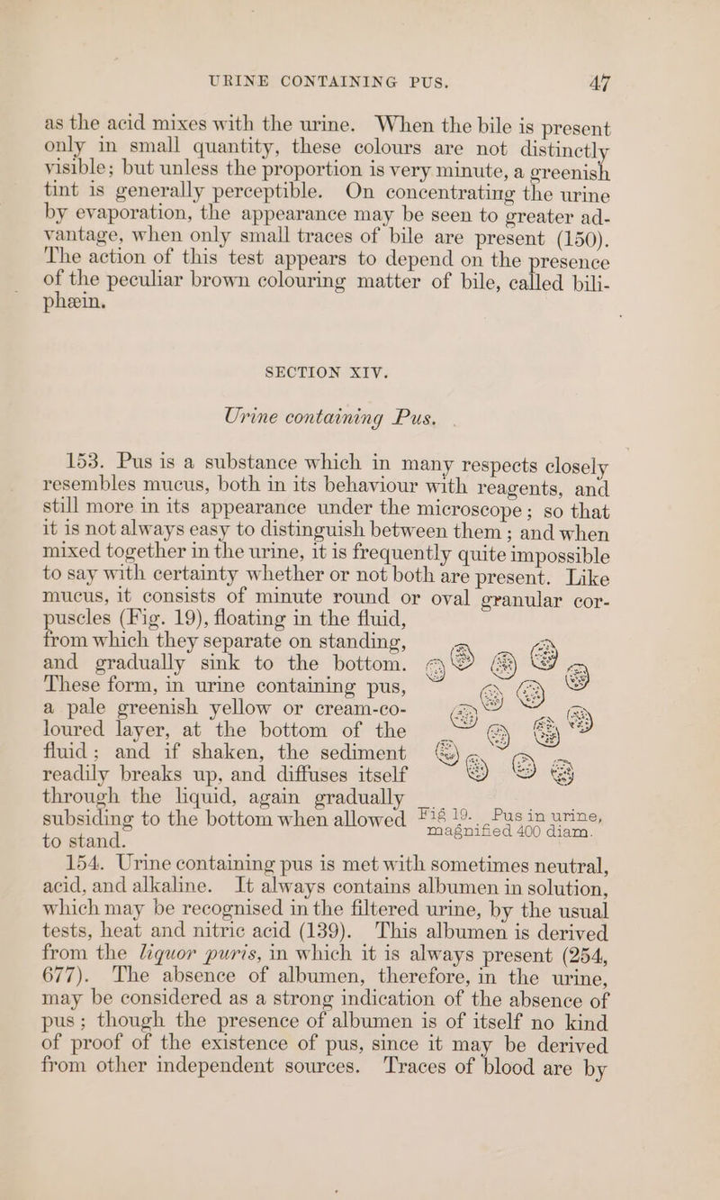 as the acid mixes with the urine. When the bile is present only in small quantity, these colours are not distinctly visible; but unless the proportion is very minute, a greenish tint is generally perceptible. On concentrating the urine by evaporation, the appearance may be seen to greater ad- vantage, when only small traces of bile are present (150). The action of this test appears to depend on the presence of the peculiar brown colouring matter of bile, called bili- pheein. SECTION XIV. Urine containing Pus. 153. Pus is a substance which in many respects closely resembles mucus, both in its behaviour with reagents, and still more in its appearance under the microscope; so that it is not always easy to distinguish between them ; and when mixed together in the urine, it is frequently quite impossible to say with certainty whether or not both are present. Like mucus, it consists of minute round or oval granular cor- puscles (Fig. 19), floating in the fluid, from which they separate on standing, and gradually sink to the bottom. These form, in urine containing pus, a pale greenish yellow or cream-co- loured layer, at the bottom of the fluid; and if shaken, the sediment readily breaks up, and diffuses itself through the liquid, again gradually __ ea ie ee to the bottom when allowed gate ie Fan ee 154. Urine containing pus is met with sometimes neutral, acid, and alkaline. It always contains albumen in solution, which may be recognised in the filtered urine, by the usual tests, heat and nitric acid (139). This albumen is derived from the liquor puris, in which it is always present (254, 677). The absence of albumen, therefore, in the urine, may be considered as a strong indication of the absence of pus; though the presence of albumen is of itself no kind of proof of the existence of pus, since it may be derived from other independent sources. Traces of blood are by