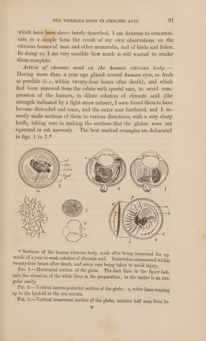 which have been above briefly described, I am desirous to communi- cate in a simple form the result of my own observations on the vitreous humor of man and other mammalia, and of birds and fishes. In doing so, I am very sensible how much is still wanted to render them complete. Action of chromic acid on the human vitreous body. — Having more than a year ago placed several human eyes, as fresh as possible (¢. e. within twenty-four hours after death), and which had been removed from the orbits with special care, to avoid com- pression of the humors, in dilute solution of chromic acid (the strength indicated by a light straw colour), I soon found them to have become distended and tense, and the outer coat hardened, and I re- cently made sections of them in various directions, with a very sharp knife, taking care in making the sections that the globes were not squeezed or cut unevenly. ‘The best marked examples are delineated in figs. 1 to 7.* * Sections of the human vitreous body, made after being immersed for up- wards of a year in weak solution of chromic acid. Immersion commenced within twenty-four hours after death, and every care being taken to avoid injury. Fic. 1.—Horizontal section of the globe. The dark lines in the figure indi- cate the situation of the white lines in the preparation ; in the centre is an irre- gular cavity. Fra. 2.—Vertical antero-posterior section of the globe ; a, white lines running up to the hyaloid at the ora serrata. Fig. 3.—Vertical transverse section of the globe, anterior half seen from be- H