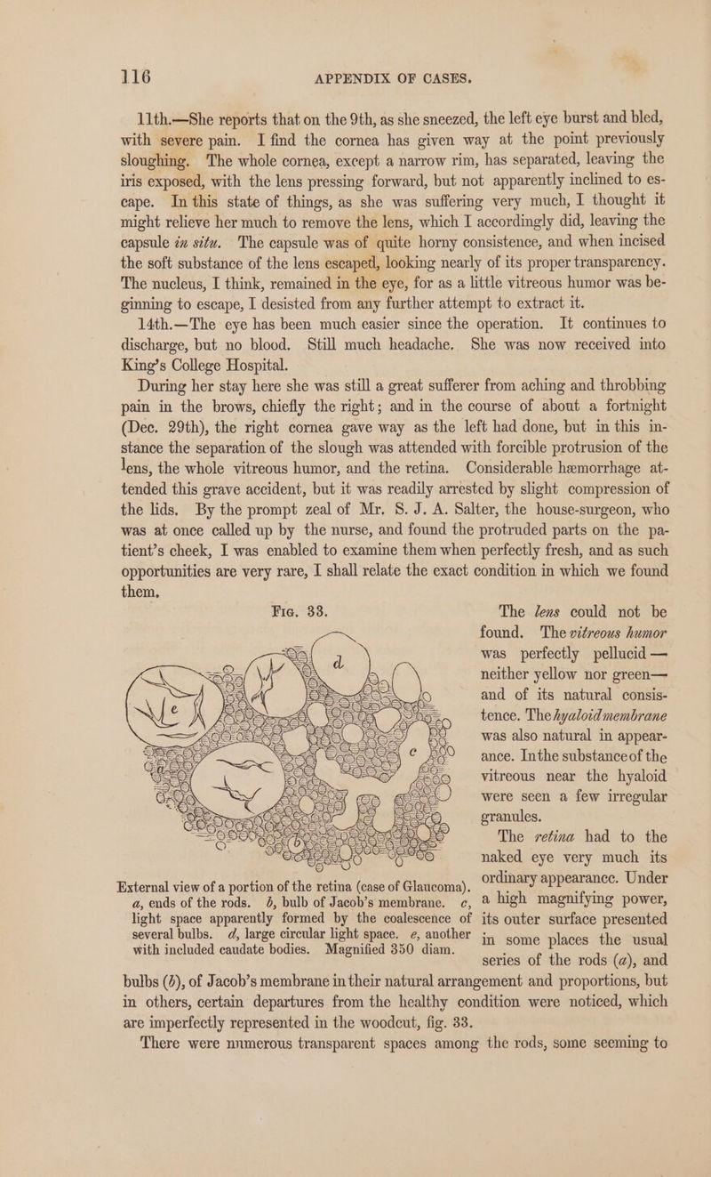 11th.—She reports that on the 9th, as she sneezed, the left eye burst and bled, with severe pain. I find the cornea has given way at the point previously sloughing. The whole cornea, except a narrow rim, has separated, leaving the iris exposed, with the lens pressing forward, but not apparently inclined to es- cape. In this state of things, as she was suffering very much, I thought it might relieve her much to remove the lens, which I accordingly did, leaving the capsule iz site. The capsule was of quite horny consistence, and when incised the soft substance of the lens escaped, looking nearly of its proper transparency. The nucleus, I think, remained in the eye, for as a little vitreous humor was be- ginning to escape, I desisted from any further attempt to extract it. 14th.—The eye has been much easier since the operation. It continues to discharge, but no blood. Still much headache. She was now received into King’s College Hospital. During her stay here she was still a great sufferer from aching and throbbing pain in the brows, chiefly the right; and in the course of about a fortnight (Dec. 29th), the right cornea gave way as the left had done, but in this in- stance the separation of the slough was attended with forcible protrusion of the lens, the whole vitreous humor, and the retina. Considerable hemorrhage at- tended this grave accident, but it was readily arrested by slight compression of the lids. By the prompt zeal of Mr. 8. J. A. Salter, the house-surgeon, who was at once called up by the nurse, and found the protruded parts on the pa- tient’s cheek, I was enabled to examine them when perfectly fresh, and as such opportunities are very rare, I shall relate the exact condition in which we found them, Fie. 33. The dens could not be found. The vitreous humor was perfectly pellucid — neither yellow nor green— and of its natural consis- tence. The hyaloid membrane was also natural in appear- ance. Inthe substanceof the vitreous near the hyaloid were seen a few irregular granules. The retina had to the naked eye very much its External view of a portion of the retina (case of Glaucoma). peg ee a, ends of the rods. 4, bulb of Jacob’s membrane. c, ® high magnifying power, light space apparently formed by the coalescence of its outer surface presented several bulbs. d, large circular light space. e, another ; with included caudate bodies. Magnified 350 diam. “ce ae Bee Boos series of the rods (a), and bulbs (2), of Jacob’s membrane in their natural arrangement and proportions, but in others, certain departures from the healthy condition were noticed, which are imperfectly represented in the woodcut, fig. 33. There were numerous transparent spaces among the rods, some seeming to