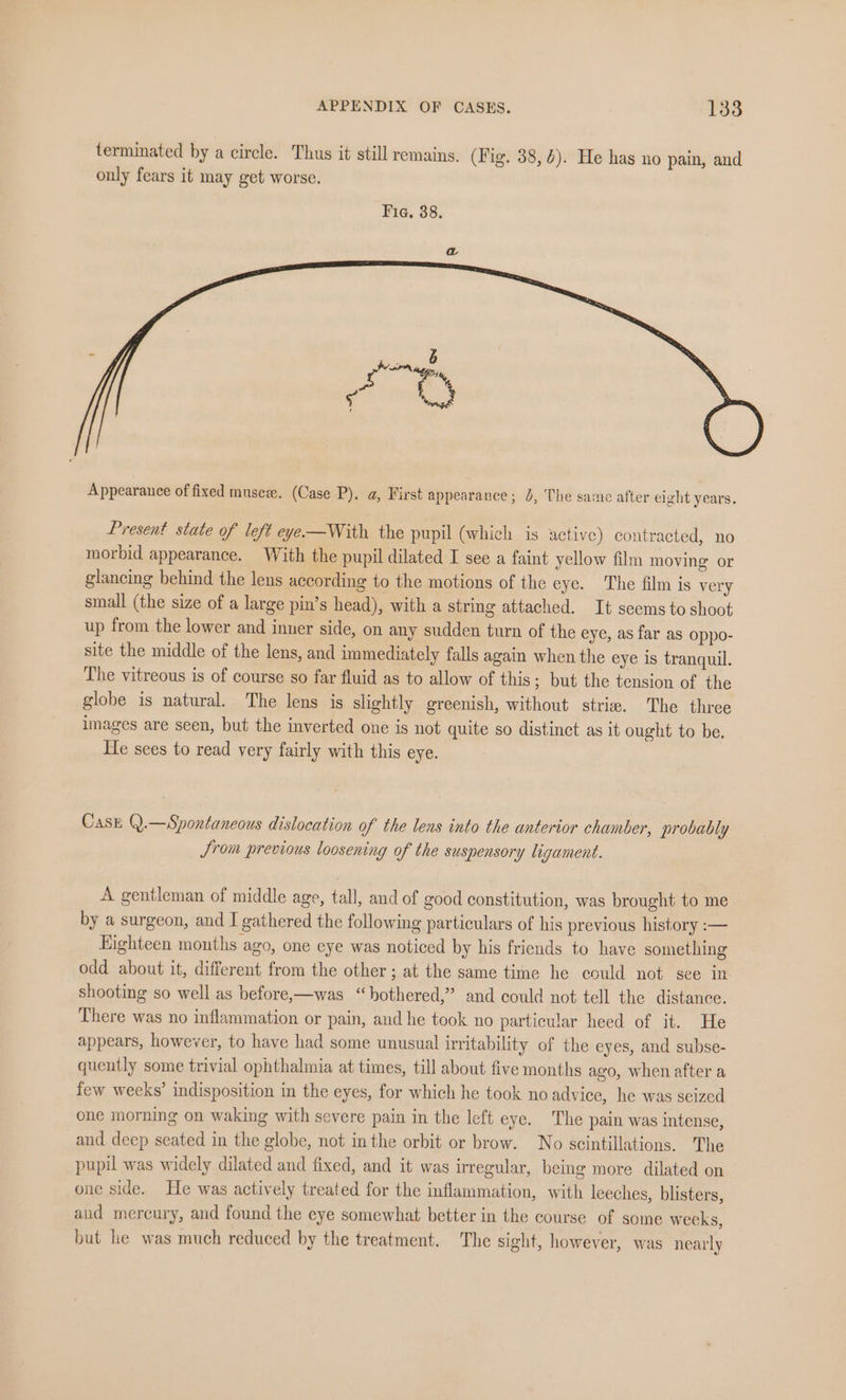 terminated by a circle. Thus it still remains. (Fig. 38, 4). He has no pain, and only fears it may get worse. Fig. 38. Present state of left eye—With the pupil (which is active) contracted, no morbid appearance. With the pupil dilated I see a faint yellow film moving or glancing behind the lens according to the motions of the eye. The film is very small (the size of a large pin’s head), with a string attached. It seems to shoot up from the lower and inuer side, on any sudden turn of the eye, as far as oppo- site the middle of the lens, and immediately falls again when the eye is tranquil. The vitreous is of course so far fluid as to allow of this; but the tension of the globe is natural. The lens is slightly greenish, without strie. The three images are seen, but the inverted one is not quite so distinct as it ought to be. He sees to read very fairly with this eye. Case Q.—Spontaneous dislocation of the lens into the anterior chamber, probably Srom previous loosening of the suspensory ligament. A gentleman of middle age, tall, and of good constitution, was brought to me by a surgeon, and I gathered the following particulars of his previous history :— Eighteen mouths ago, one eye was noticed by his friends to have something odd about it, different from the other ; at the same time he could not see in shooting so well as before,—was “bothered,” and could not tell the distance. There was no inflammation or pain, and he took no particular heed of it. He appears, however, to have had some unusual irritability of the eyes, and subse- quently some trivial ophthalmia at times, till about five months ago, when after a few weeks’ indisposition in the eyes, for which he took no advice, he was seized one morning on waking with severe pain in the left eye. The pain was intense, and deep seated in the globe, not in the orbit or brow. No scintillations. The pupil was widely dilated and fixed, and it was irregular, being more dilated on one side. He was actively treated for the inflammation, with leeches, blisters, aud mercury, and found the eye somewhat better in the course of some weeks, but he was much reduced by the treatment. The sight, however, was nearly