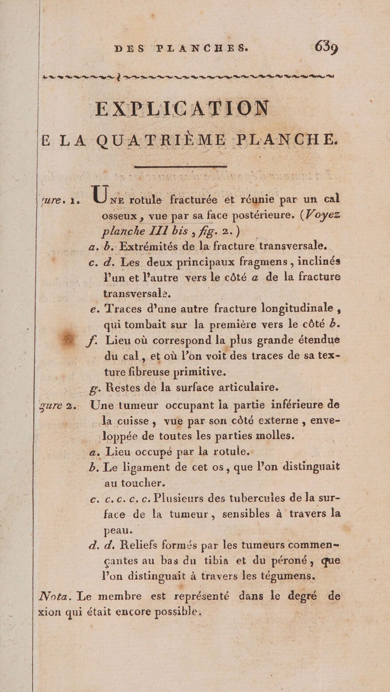 re S L À A —————————————_——_———— ———————2——2 a , osseux , vue par sa face postérieure. (Woyez Ébasle III bis , fig. 2.) | a. b. Extrémités de la fracture transversale. c. d. Les deux principaux fragmens, inclinés l’un et l’autre vers le côté a de la fracture transversale. is e. Traces d’une autre fracture longitudinale, qui tombait sur la première vers le côté &amp;. ! f. Lieu où correspond la plus grande étendue du cal, et où l’on voit des traces de sa tex- ture au primitive. g. Restes de la surface articulaire. Une tumeur occupant ia partie inférieure de la cuisse, vue par son côté externe , enve- loppée de toutes les parties molles. b. Le ligament de cet os, que l’on distinguait au toucher. c. cc. c. c. Plusieurs des tubercuies de la sur- face de la tumeur, sensibles à travers la peau. d. d, Reliefs formés par les tumeurs commen- çantes au bas du tibia et du péroné, que l’on distinguait à travers les tégumens.