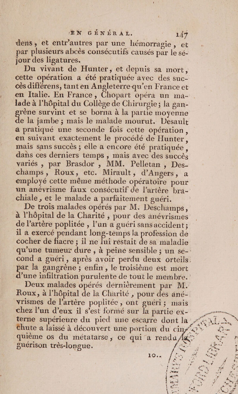 dens, et entr'autres par une hémorragie, et par plusieurs abcès consécutifs causés par le sé- jour des ligatures. Du vivant de Hunter, et depuis sa mort, cette opération a été pratiquée avec des suc- cès différens, tant en Angleterre-qu’en France et en Italie. En France, Chopart opéra un ma- lade à l'hôpital du Collège de Chirurgie; la gan- rène survint et se borna à la partie moyenne de la jambe ; mais le malade mourut. Desault a pratiqué une seconde fois cette opération, en suivant exactement le procédé de Hunter, mais sans succès ; elle à encore été pratiquée, dans ces derniers temps , mais avec des succès variés , par Brasdor , MM. Pelletan , Des- champs, Roux, etc. Mirault, d'Angers, a employé cette même méthode opératoire pour un anévrisme faux consécutif de l’artère bra- chiale , et le malade a parfaitement guéri. _ De trois malades opérés par M. Deschamps, à l'hôpital de la Charité , pour des anévrismes de l'artère poplitée , l’un a guéri sans accident ; il à exercé pendant long-témps la profession de cocher de fiacre ; il ne lui réstait de sa maladie par la gangrène ; enfin , le troisième est mort Roux, à l'hôpital de la Charité , pour des ané- vrismes de l'artère poplitée , ont guéri; mais chez l’un d’eux il s’est formé sur la partie ex- terne supérieure du pied une escarre dont la quième os du métatarse, ce qui a rendu, guérison très-lonsue. *@ if W 7 A ?, ve